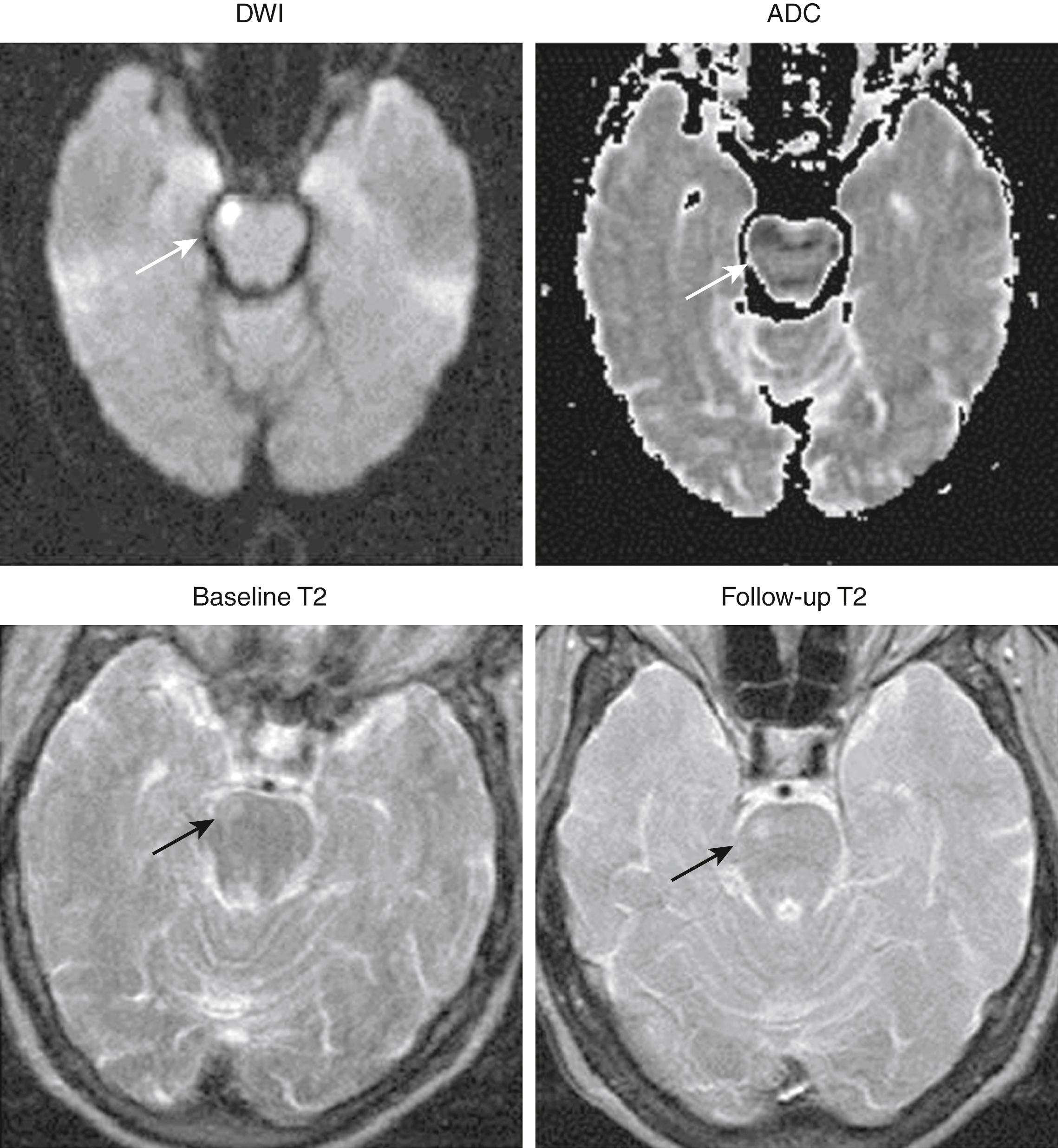 Fig. 48.7, Baseline and follow-up MRI in a patient with TIA. An acute ischemic lesion is evident on the baseline MRI as a bright lesion on the DWI sequence (top left) and as a dark lesion on the ADC map (top right), but is inconspicuous on the T2 sequence. Follow-up imaging demonstrates a subsequent infarct in the region corresponding to the original DWI abnormality. ADC, Apparent diffusion coefficient; DWI, diffusion-weighted imaging; MRI, magnetic resonance image; TIA, transient ischemic attack.