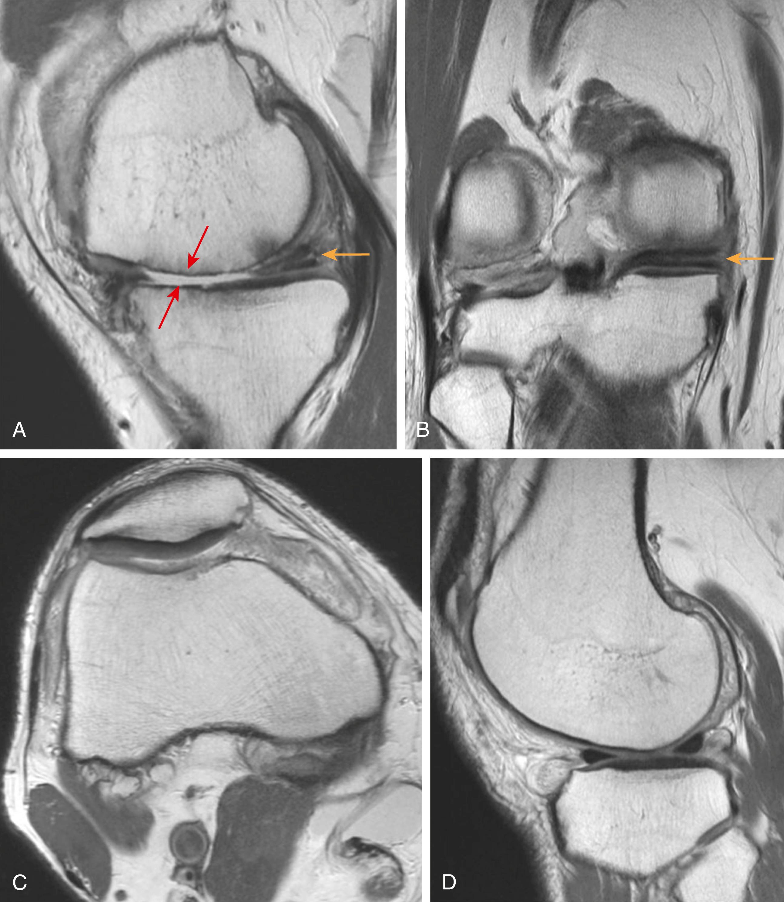 Fig. 3.2, Tricompartmental osteoarthritis with (A) bone on bone apposition over the medial tibiofemoral compartment (red arrows), (A) and (B) chronically torn and degraded medial meniscus with a horizontal component (yellow arrows) and (C) and (D) severe synovitis within all synovial recesses, indicative of a patient with osteoarthritis who expresses inflammatory mediators.