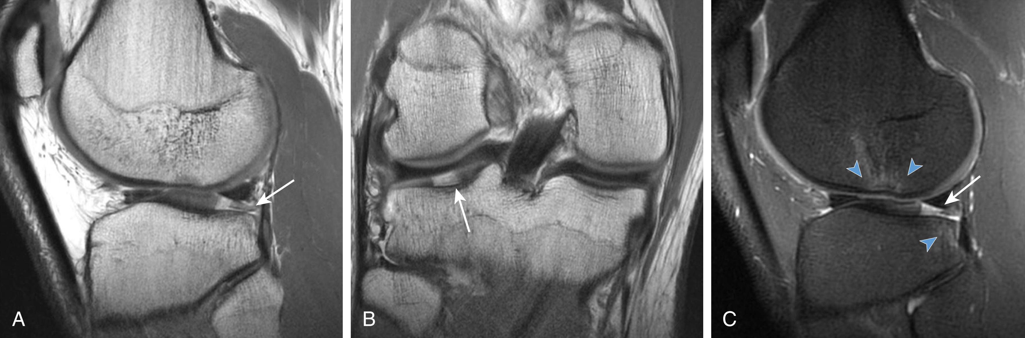 Fig. 3.3, (A) Sagittal proton density magnetic resonance (PD MR) images, (B) coronal PD MR and (C) sagittal inversion recovery MR images demonstrate sequela of an anterior cruciate ligament injury producing a full-thickness cartilage defect with a loose fragment in the posterolateral tibial articular cartilage (white arrows) and a bone marrow oedema pattern in the lateral femoral condyle and tibial plateau (blue arrowheads).