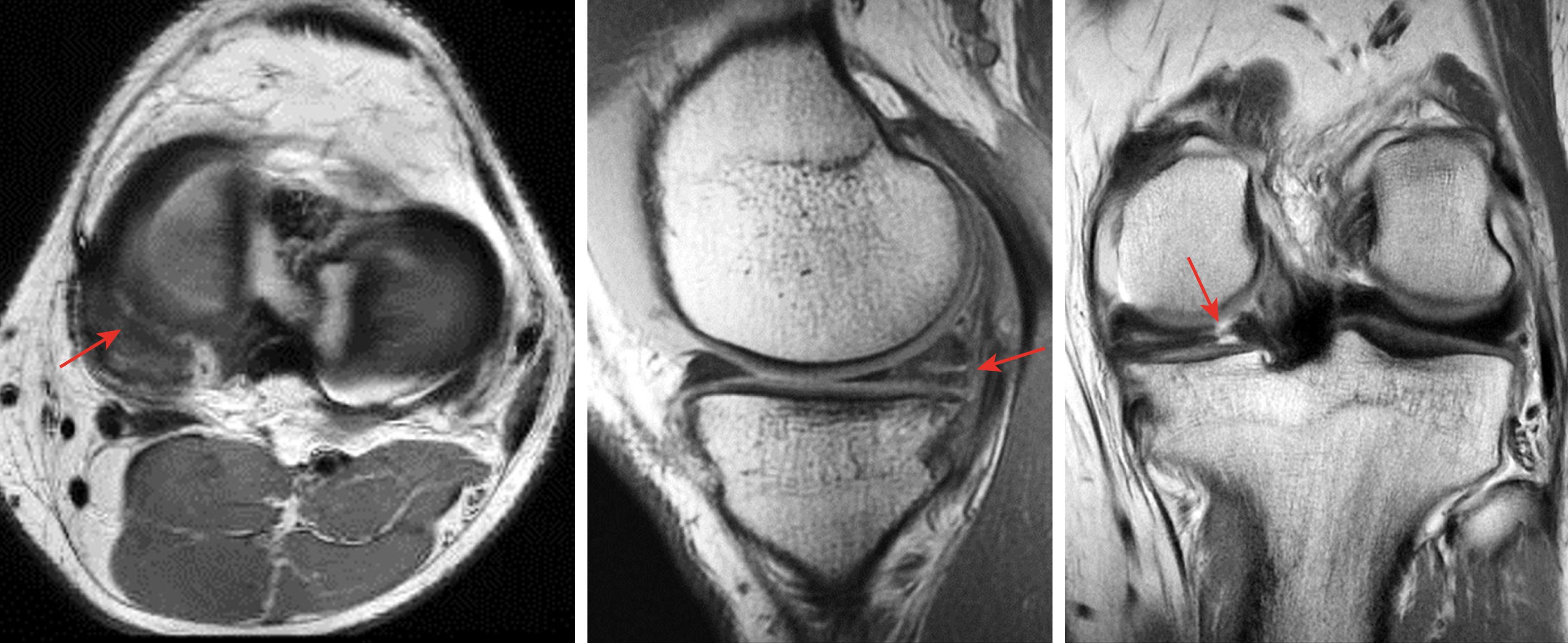 Fig. 3.4, Complex medial meniscal tear with chronic horizontal degeneration posterior horn body junction and a superimposed complete radial split through close to the root attachment of the posterior horn (red arrows).