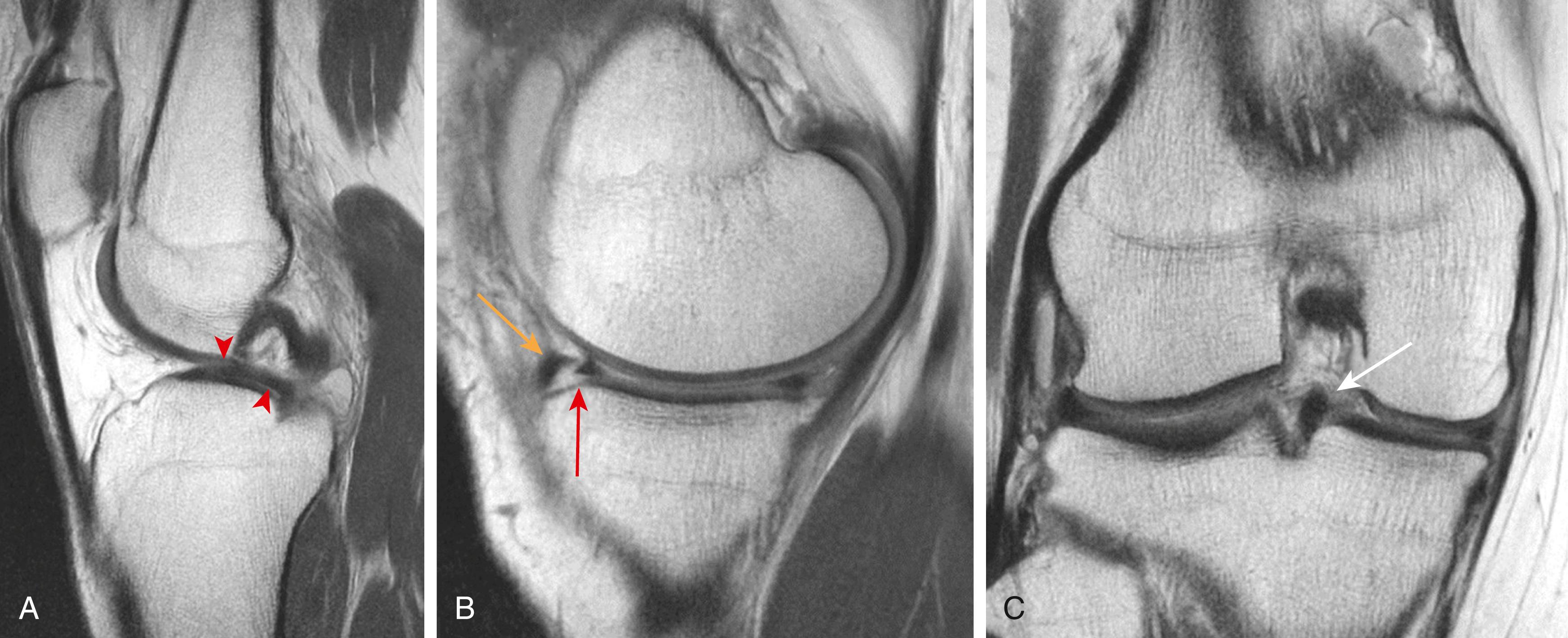 Fig. 3.5, A 21-year-old woman exhibiting unreduced bucket handle tear of the medial meniscus.