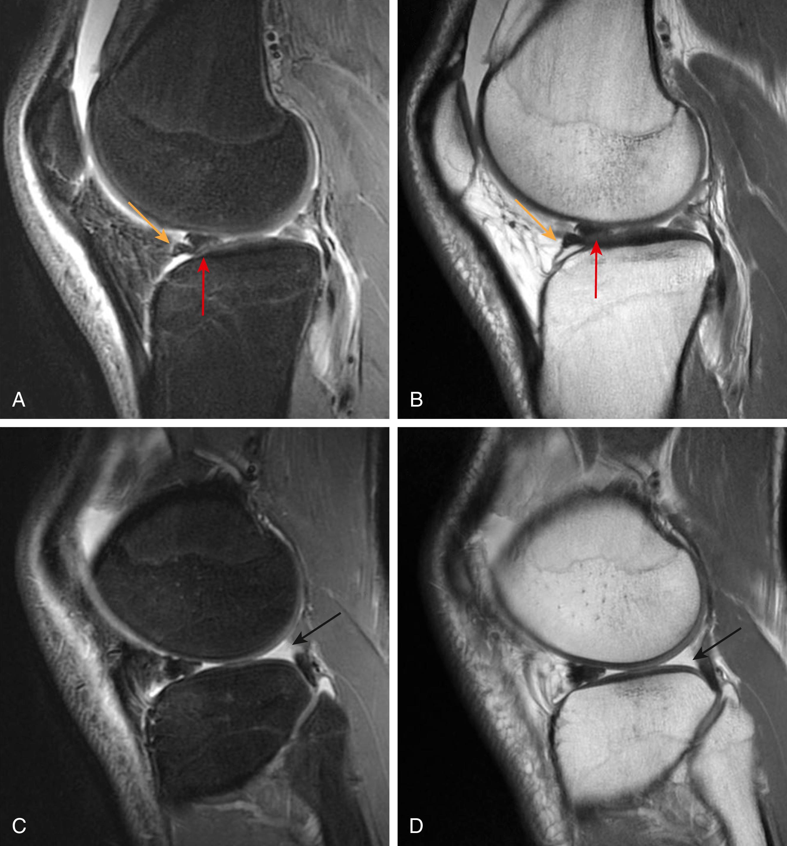 Fig. 3.6, (A) and (C) sagittal T2 weighted, fat-suppressed and (B) and (D) proton density magnetic resonance images demonstrate a bucket handle tear of the lateral meniscus with a double delta sign (A) and (B) with the displaced posterior horn (red arrow) positioned just posterior to the native anterior horn (yellow arrow). The flipped posterior horn results in a ghost meniscus (black arrow) with an absent posterior horn remnant (C) and (D).