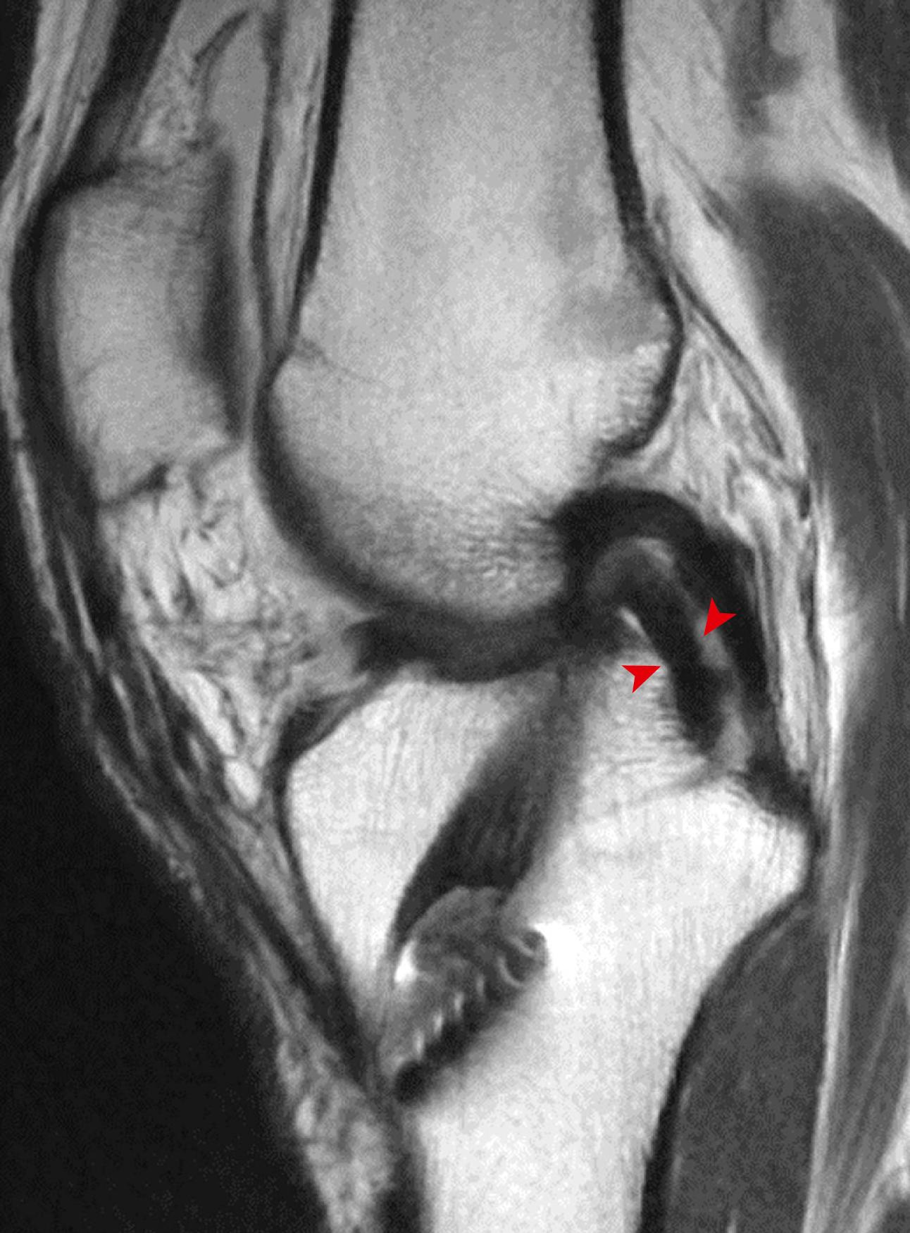 Fig. 3.7, Sagittal proton density magnetic resonance image demonstrating a double posterior cruciate ligament sign (red arrowheads) associated with an unreduced bucket handle tear of the medial meniscus in a patient status post–anterior cruciate ligament reconstruction.
