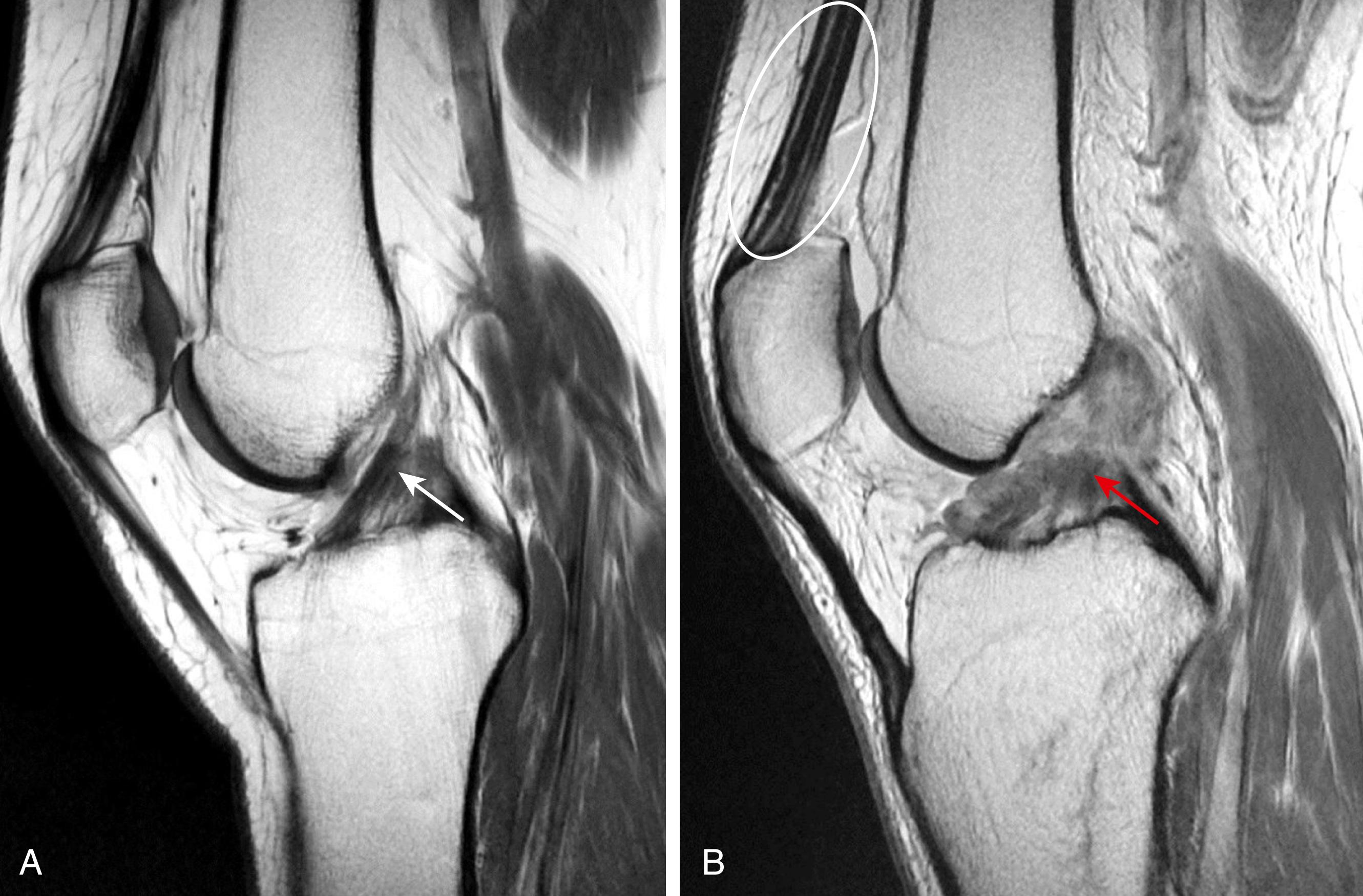 Fig. 3.8, Sagittal proton density magnetic resonance images of (A) a normal, intact anterior cruciate ligament (ACL; white arrow ); (B) complete midsubstance tear of the ACL (red arrow). Note that normal fibrofatty connective tissue present between the layers of the quadriceps tendon results in longitudinal streaks of intermediate signal within the otherwise hypointense quadriceps tendon (white circle).