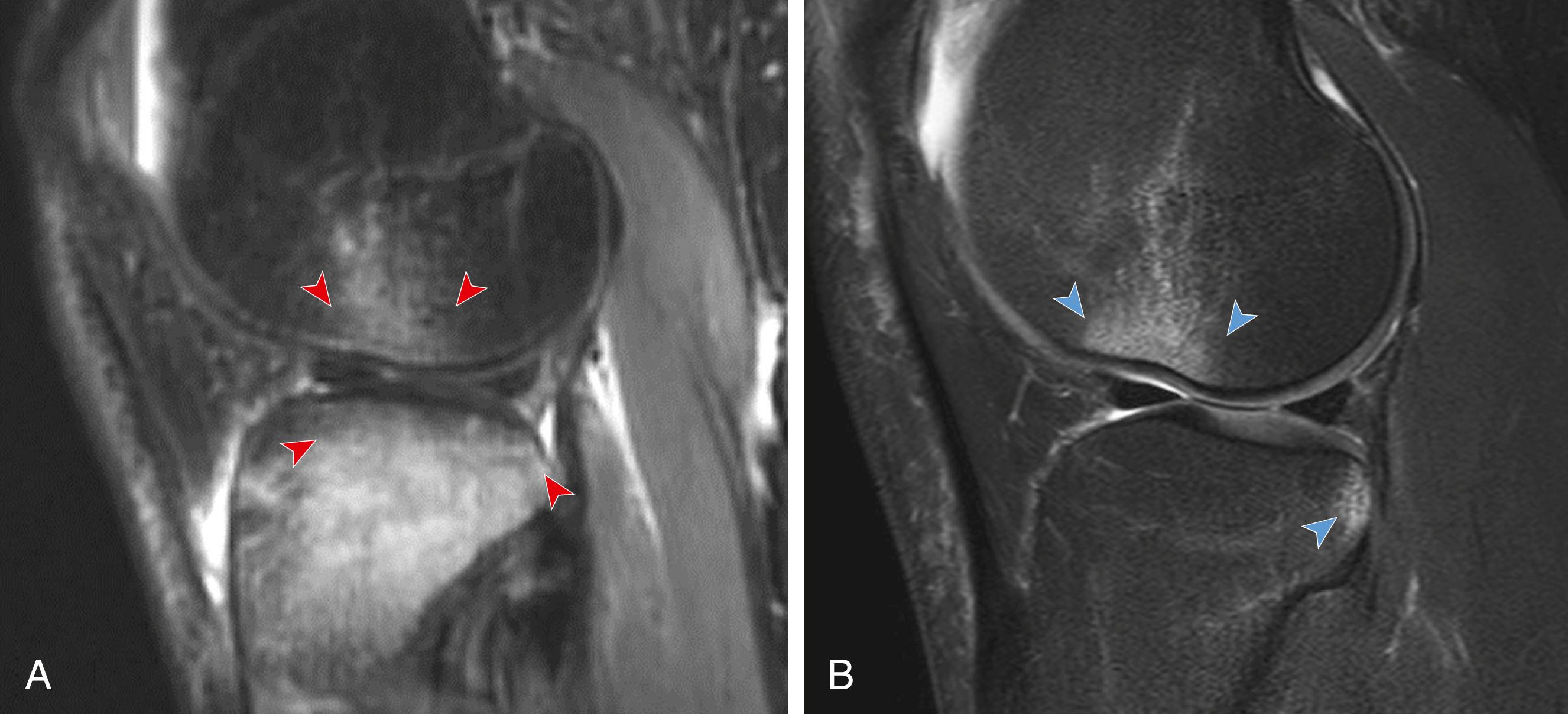 Fig. 3.9, Sagittal inversion recovery magnetic resonance (MR) image (A) demonstrates sequela of a valgus impaction injury with bone marrow oedema pattern in the lateral femoral condyle and tibial plateau (red arrowheads). Sagittal inversion recovery MR image (B) illustrates ‘kissing’ bone marrow oedema pattern in the posterolateral tibia and central lateral femoral condyle (blue arrowheads) representing transchondral impaction injuries after an anterior cruciate ligament rupture with secondary pivot shift.