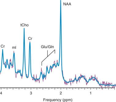 Figure 25.1, 1 H spectra of occipital gray matter acquired in a control subject.