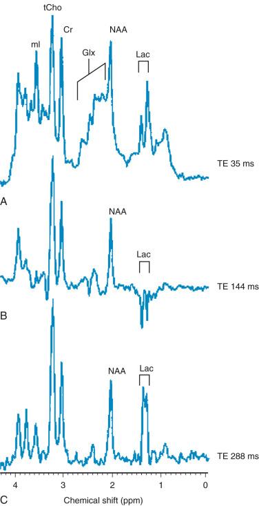 Figure 25.2, Comparison of magnetic resonance spectroscopy (MRS) of neonatal hypoxic-ishemic encephalopathy (acquired at multiple echo times [TEs]) with neonatal metabolic disease.