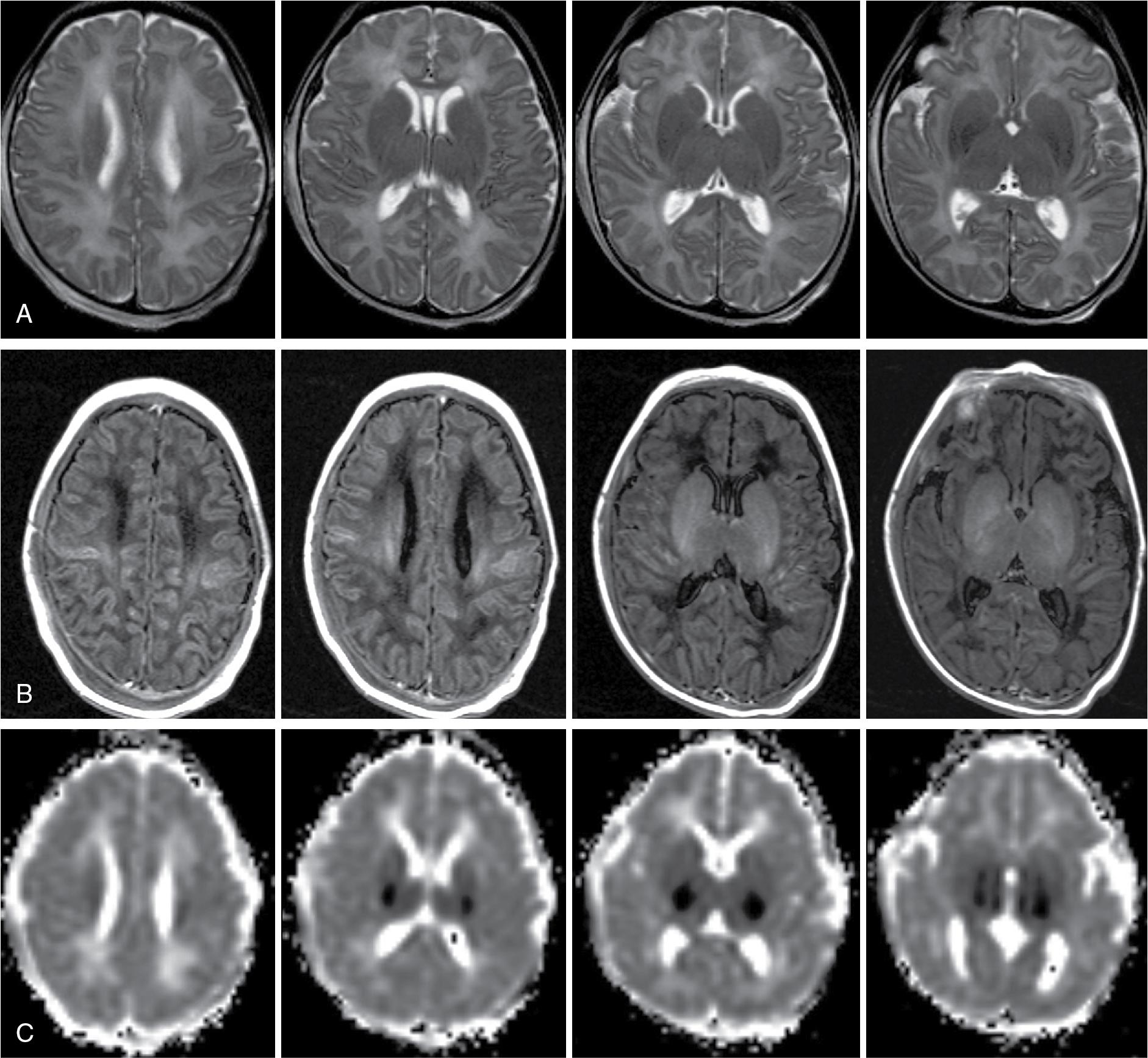 Fig. 15.1, Case 1 with perinatal asphyxia and MRI at day 3 of life. A, T2-weighted images with slight T2 hyperintensity of the thalami, no striking signal abnormalities. B, T1-weighted images show abnormal high signal intensities in several cortical areas, specifically in the depth of sulci. Thalamic area slightly hypointense. C, Diffusion-weighted imaging (DWI) shows striking lesions ( dark ) with apparent diffusion coefficient (ADC) reduction in bilateral thalami and in some discrete central cortical areas.