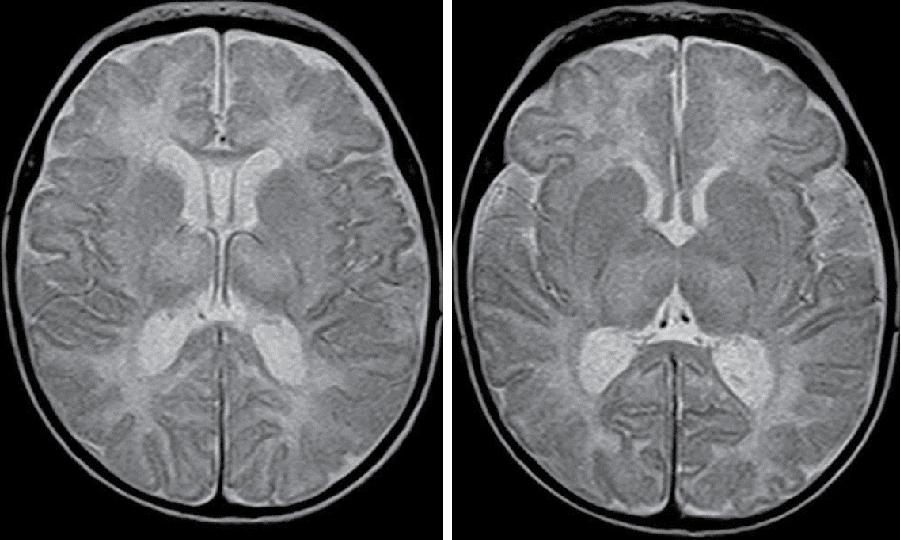 Fig. 15.2, Case 1: MRI 10 days after perinatal asphyxia. T2-weighted images show marked hyperintensities in bilateral thalami as well as the posterior limb of the internal capsule. Please note a mild ventricular dilatation as well.