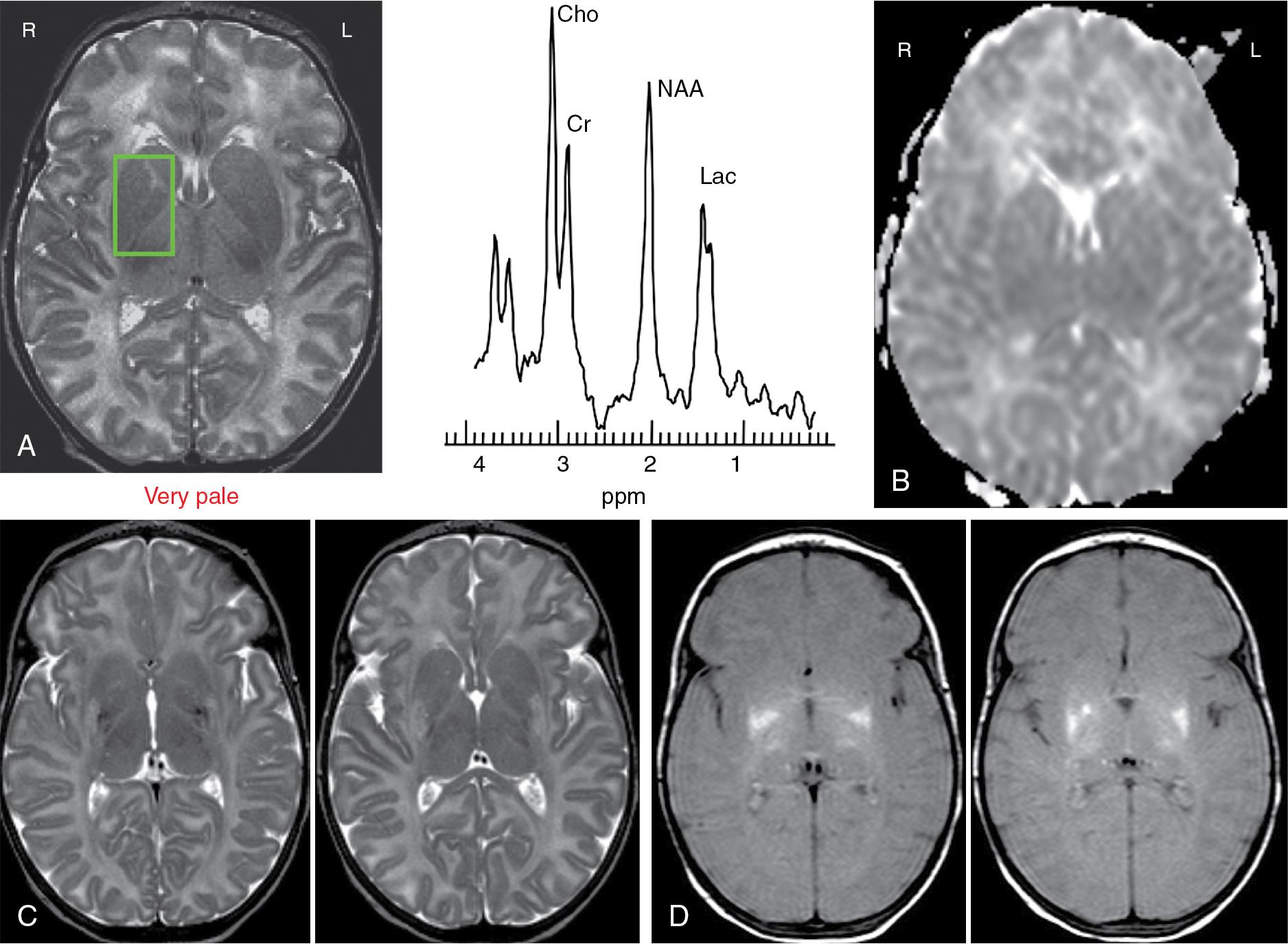 Fig. 15.3, Case 2: A, MR examination obtained at 12 hours after perinatal asphyxia. Axial T2-weighted image shows no signal abnormalities and single voxel 1 H-MRS performed over the right basal ganglia shows markedly increased lactate resonance with preserved N -acetylaspartate (NAA), Cr, and Cho resonances. B, Diffusion-weighted imaging (DWI) with axial apparent diffusion coefficient (ADC) map shows no diffusion abnormalities. C and D, MRI at 10 days after perinatal asphyxia. C, Axial T2-weighted images show areas of high signal intensity in the putamen and thalamus representing clear ischemic-lesions. D, Axial Proton density images with excellent detection of the lesion extension.