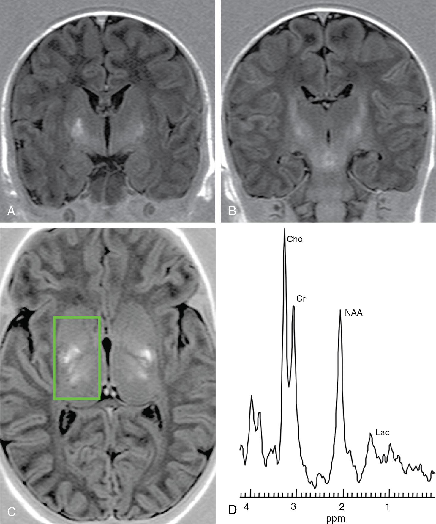 Fig. 15.4, Case 2: Coronal and axial inversion recovery sequences with T1-weighted contrast at 10 days after perinatal asphyxia. T1 hyperintensities appear irregular (A, C) (compare to regular distribution of beginning myelination in B). D, 1 H-MRS shows normalization of lactate and reduction of N -acetylaspartate (NAA) compared to 1 H-MRS at day 1.