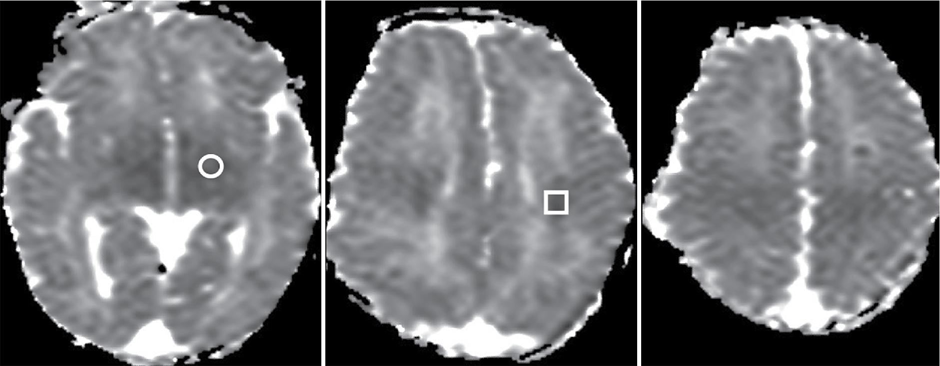 Fig. 15.5, Case 3 MRI on day 1 after perinatal asphyxia. Conventional MR Imaging reveals no signal abnormalities (not shown). DWI shows no overt lesions but ADC values measured in the left basal ganglia (ADC 0.8 mm 2 /ms) ( circle ) and central white matter (ADC 0.8 mm 2 /ms) ( square ), respectively, reveal markedly reduced ADC values compared to normal term neonates (around 1.6 mm 2 /m).