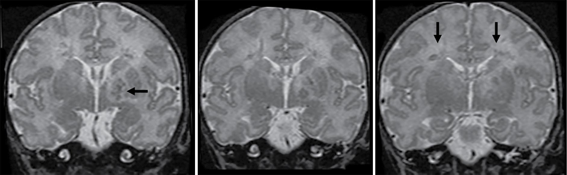 Fig. 15.6, Case 3: MRI 7 days after perinatal asphyxia. Coronal T2-weighted images showing T2 hypo- and hyperintensities in the central white matter with additional left-sided lesions in the internal capsule and lateral thalamus ( arrows ).