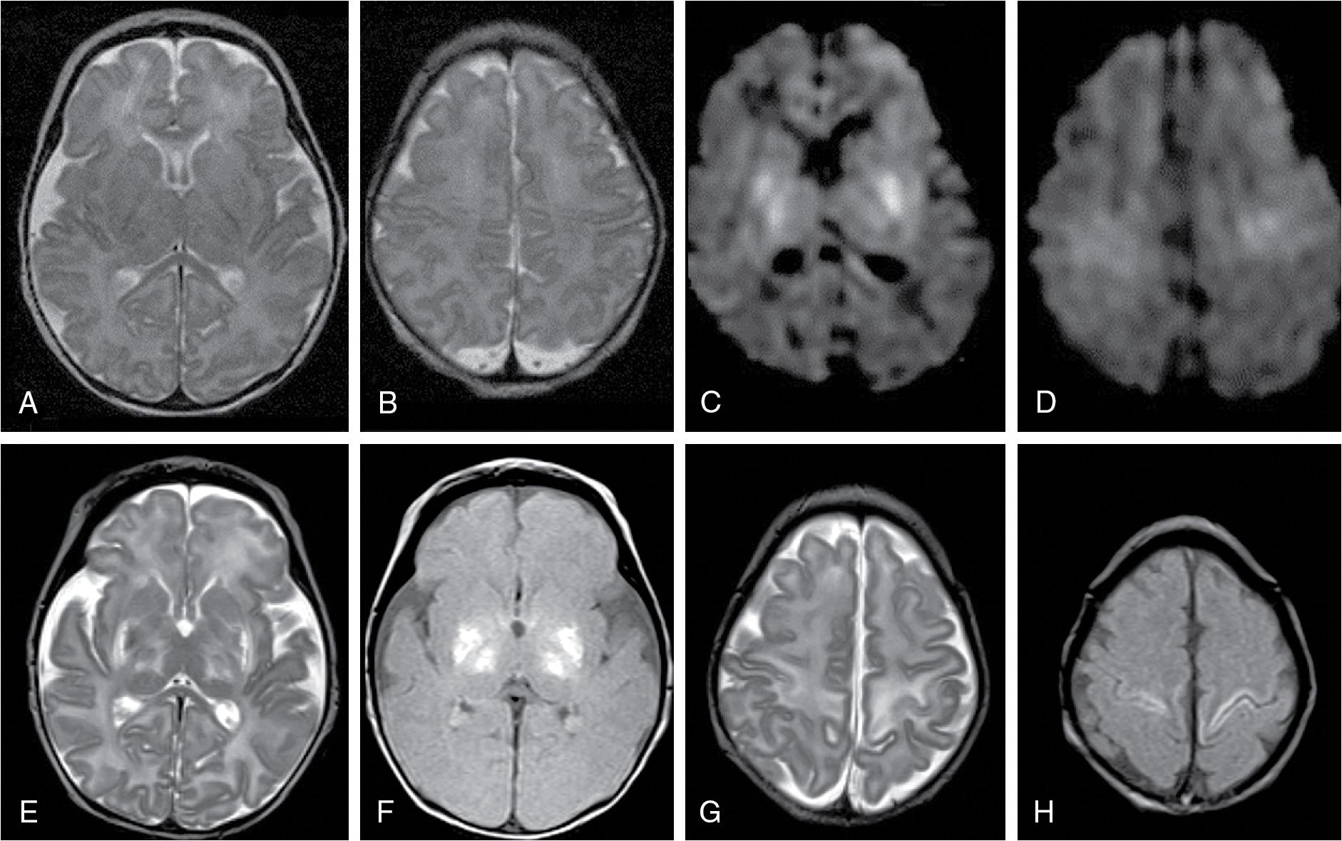 Fig. 15.7, Case 4: A–D, MRI at day 2 after perinatal asphyxia. A, B, Conventional T2-weighted images at the level of the basal ganglia and the centrum semiovale show no signal abnormalities. Diffusion-weighted imaging (DWI) shows striking hyperintensities in diffusion-weighted images in the bilateral putamen and thalamus in (C) and some high signal in the central cortex (D). MR imaging at 10 days after the insult confirms distribution of lesions with hyper- and hypointensities on T2-weighted images (E), typical high signal intensity with good lesion definition in proton density images (F), the perirolandic cortex shows typical T2 and PD hyperintensity (G, H).