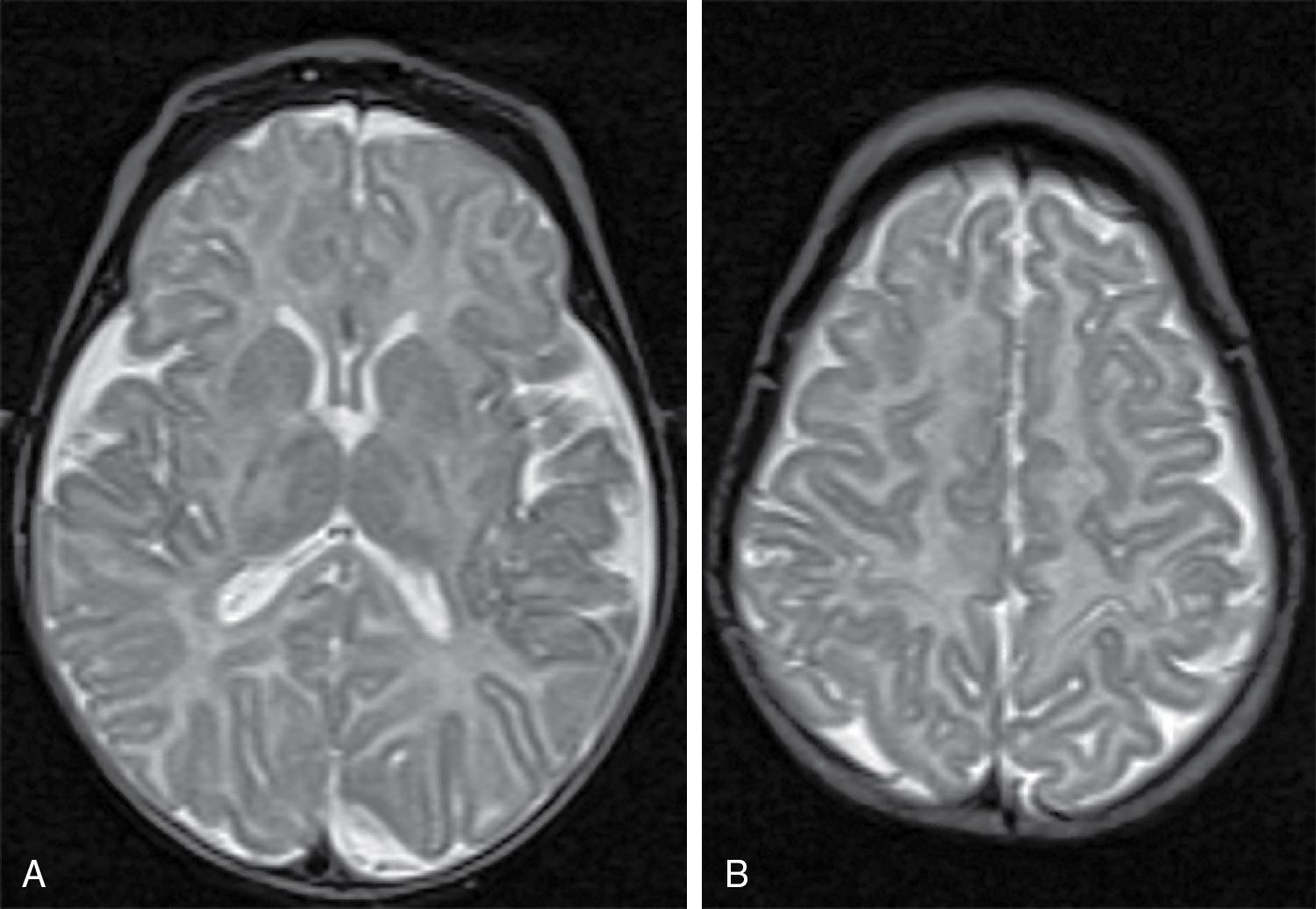 Fig. 15.8, Case 4: MR imaging at 2 months of age reveals the same lesions with marked atrophy and delay in myelination.