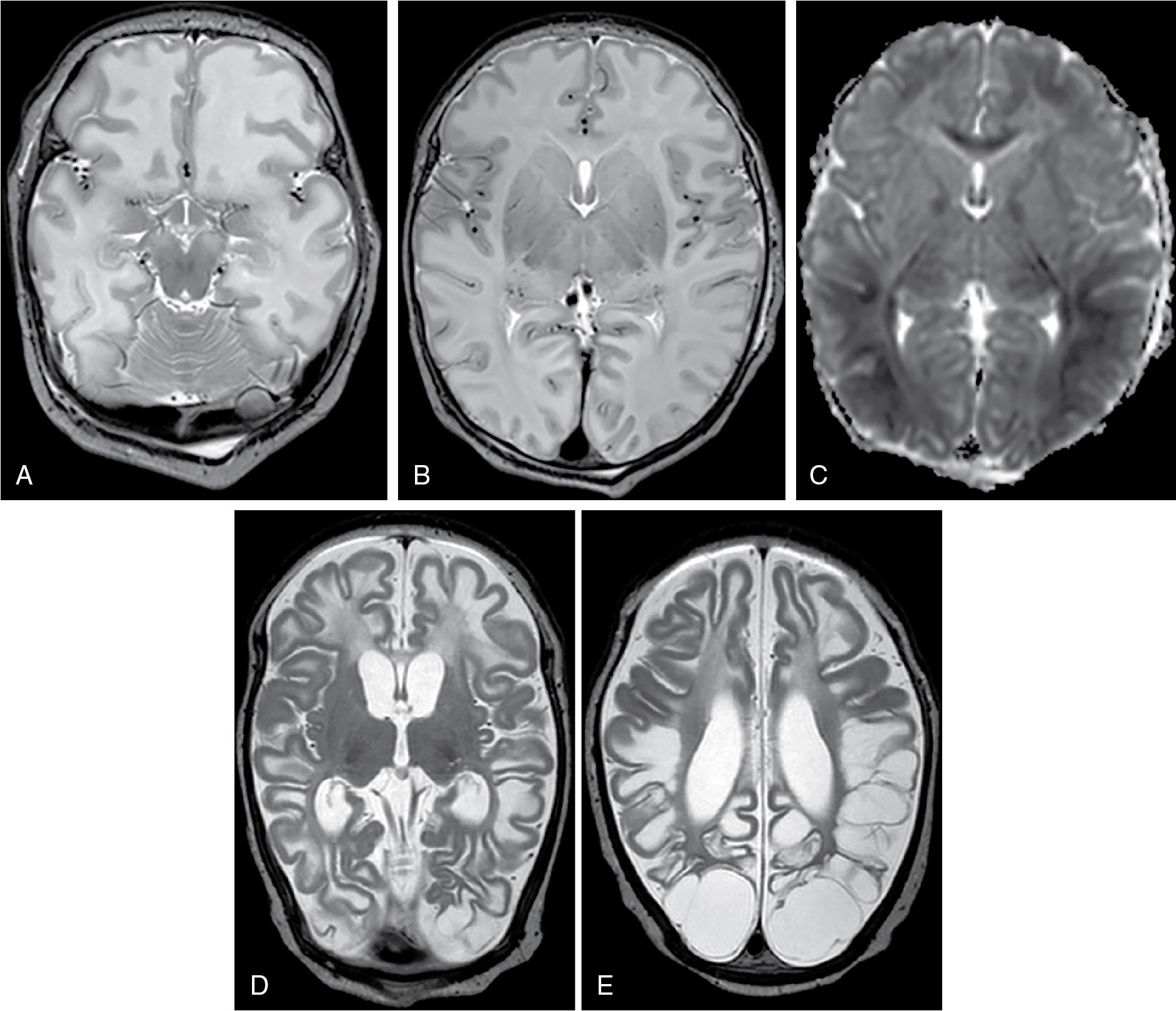 Fig. 15.9, Case 5: Neonatal head ultrasound performed on day 1 showed small ventricles and increased parenchymal echogenicity. A–C, MRI performed on day 7 demonstrated extensive signal intensity changes in the white matter and cortex with loss of gray/white matter differentiation, especially posteriorly and apparent sparing of thalami and basal ganglia except for the pulvinar. Also noted the swollen mammillary bodies with increased signal intensity on T2. On Diffusion-weighted imaging (DWI), markedly reduced apparent diffusion coefficients (ADCs) (0.70) were present in the occipital white matter, the corpus callosum but not in the thalami. D and E, Follow-up MRI 6 weeks later demonstrated evolution into multicystic encephalopathy with loss of both hemispheric gray and white matter and ex vacuo ventricular dilatation.