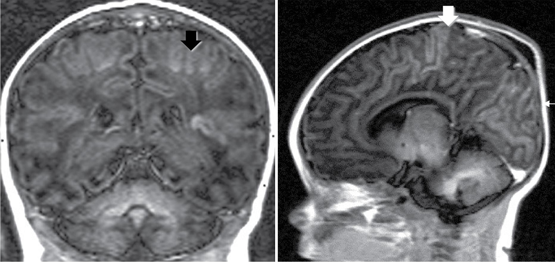 Fig. 15.10, Typical parasagittal distribution of T1 hyperintensities in cortical neuronal necrosis of deep sulcal cortex of another patient with acute perinatal asphyxia.