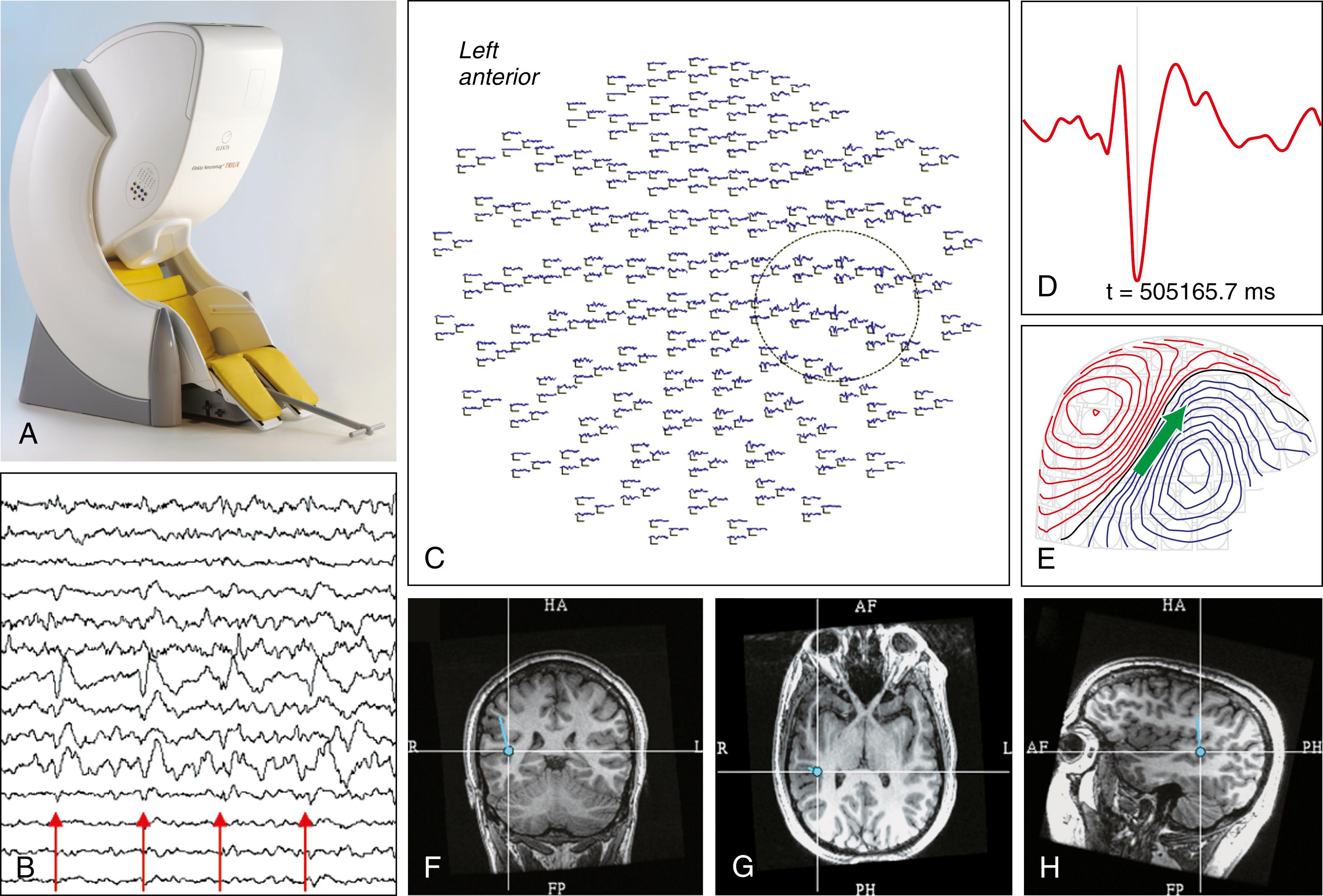 Figure 86.2, Overview of magnetoencephalography (MEG).