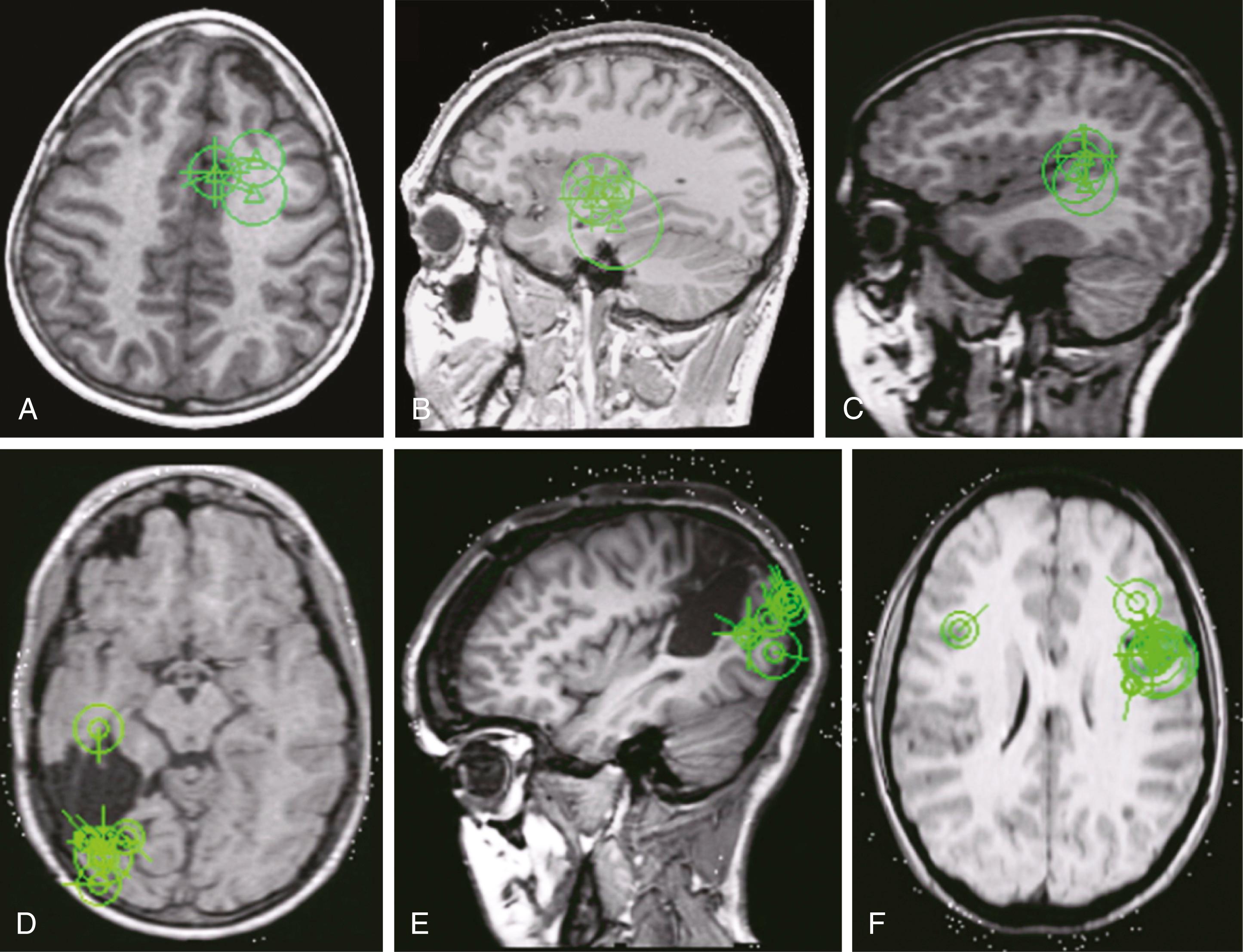 Figure 86.3, Magnetoencephalography (MEG) utilization scenarios.