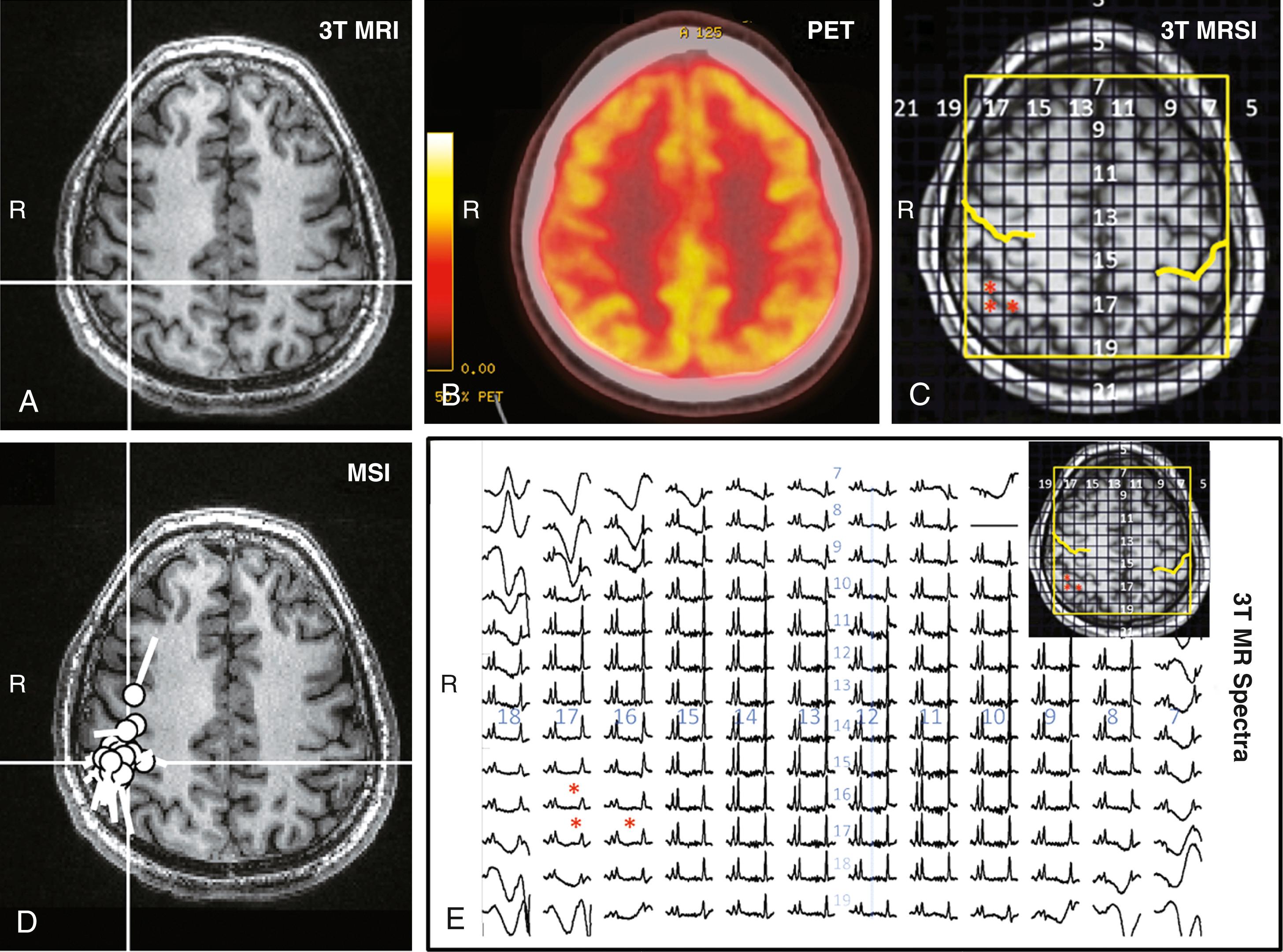 Figure 86.4, Nonlesional extratemporal epilepsy.