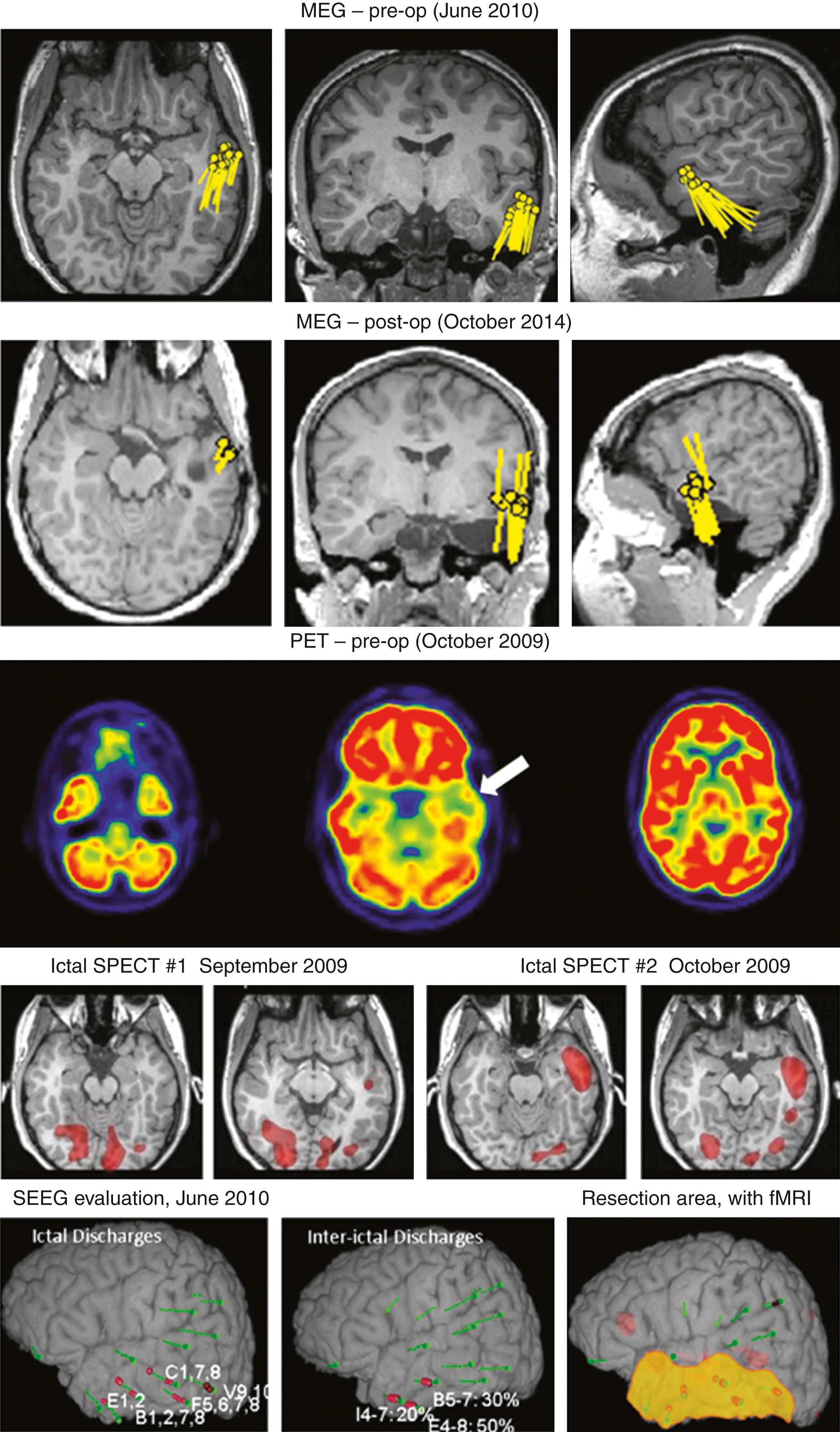 Figure 86.5, Example of comprehensive use of magnetoencephalography (MEG)/magnetic source imaging in multimodal evaluation of a complex case of drug-resistant epilepsy.