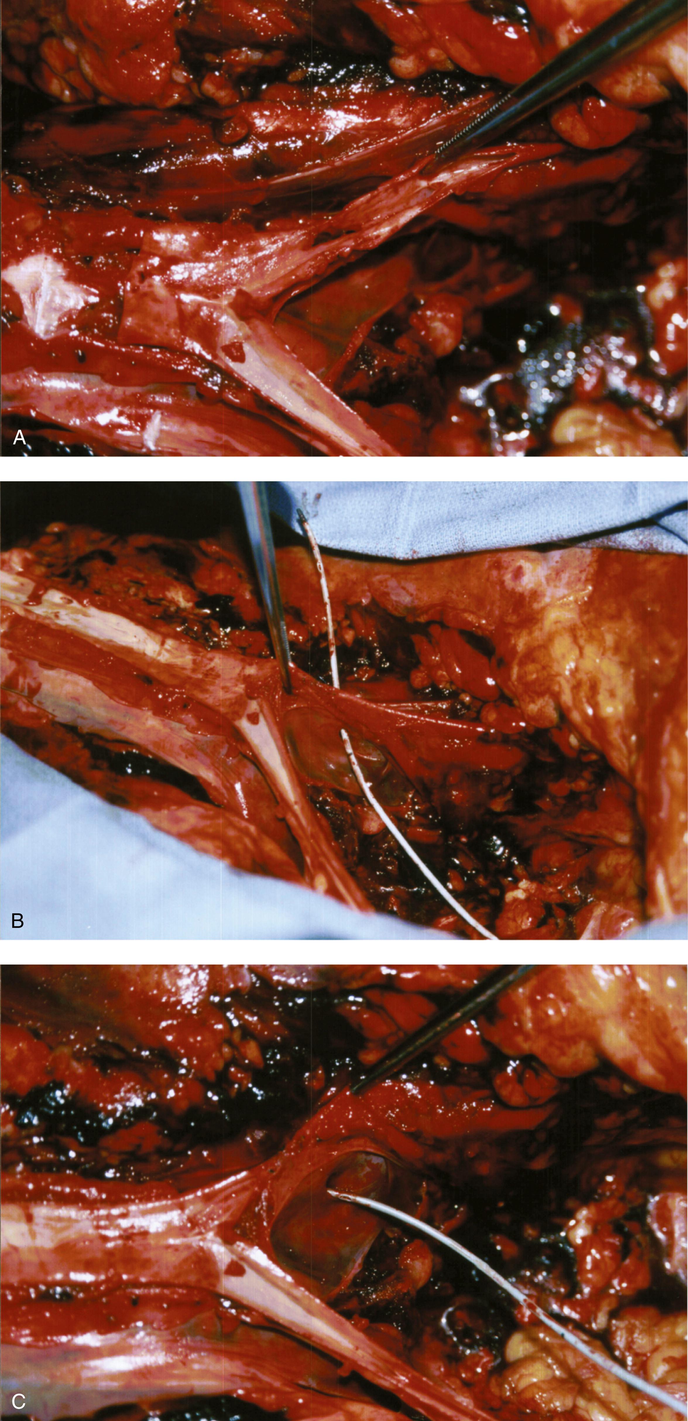 FIG. 119.1, A. Autopsy of a young woman who sustained a through-and-through trocar injury of the left common iliac artery and vein and died of massive blood loss. The area below the forceps shows the laceration on the posterior wall of the artery. B. The probe passed by the coroner enters the posterior wall of the artery and exits through the anterior wall. Vascular clips can be seen on the left common iliac vein. C. The probe points to a laceration in the left common iliac vein. This was the fatal wound. D. Autopsy showing massive injury to left common iliac artery with Gore-Tex graft. E. Magnified view of D. F. Removed aorta and trunks of common iliac arteries; note graft interposed between aortic bifurcation and left iliac artery. G. Magnified view of aorta and iliacs. A segment of the vena cava is opened and contained two puncture wounds and sutures. H. The aorta has been opened; the doublet holes on the posterior wall are perforating vessel openings.