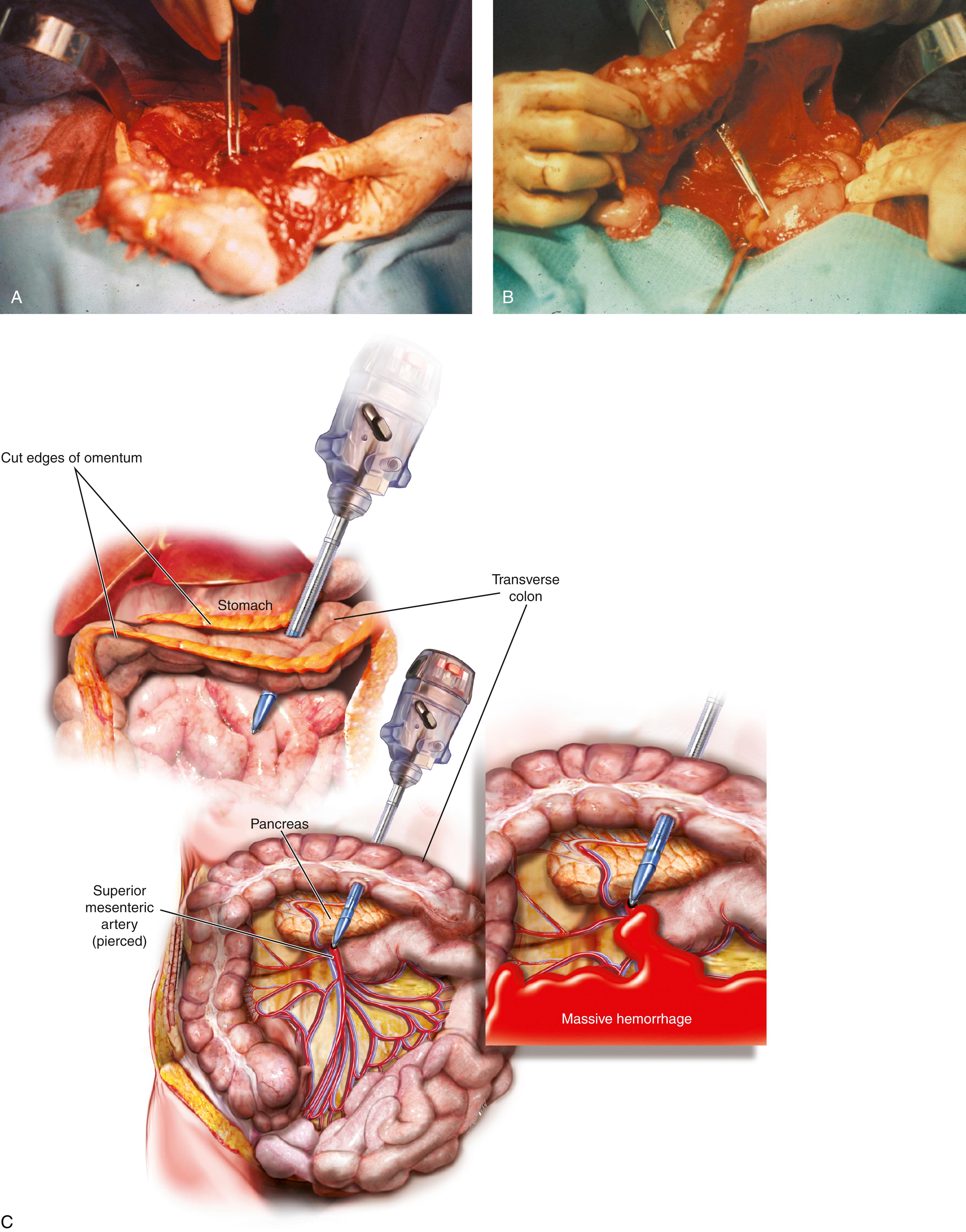 FIG. 119.2, A. The forceps has been placed in a trocar wound of the omentum. B. The transverse colon has been elevated, permitting the scissors to trace the trajectory into a trocar-induced perforation of the duodenum. C. In preparation for a robotic procedure the initial entry incision was made 4 to 5 cm above the umbilicus. The trocar was directed at an angle close to 90°. The razor-sharp trocar created a through-and-through perforation of the transverse colon and continued a deep trajectory into the superior mesenteric artery. The patient died of massive hemorrhage as a result of failure to find the injured artery and lack of measures to repair the laceration.