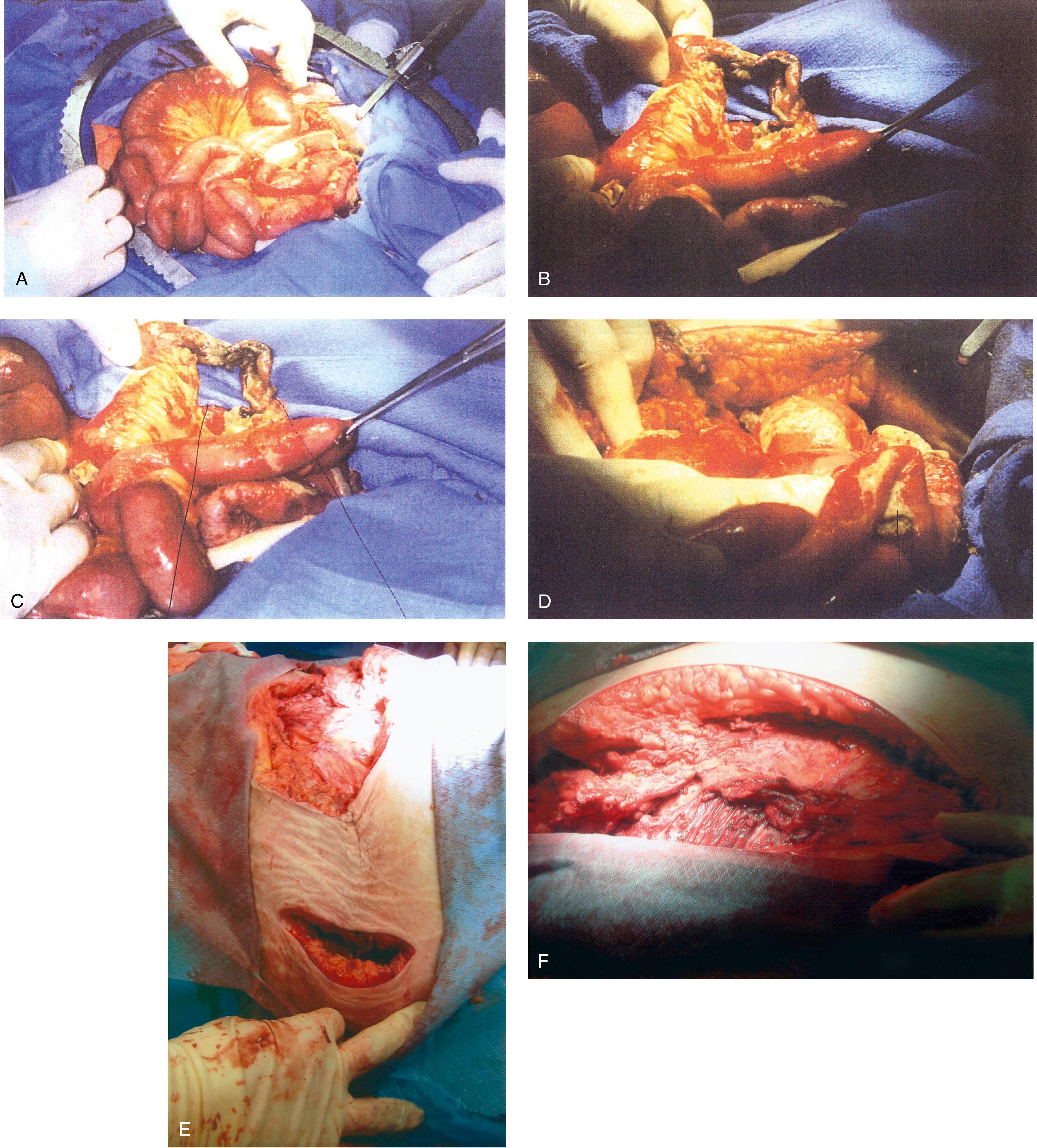 FIG. 119.3, A. This 28-year-old para 3-0-0-3 underwent a postlaparoscopy emergency laparotomy. At the time of the laparotomy, the patient had extensive peritonitis and multiple small-bowel interloop abscess formations. Note the swollen, edematous small intestine. The patient also exhibited clinical signs of septic shock. B. The mesentery of the small intestine had been coagulated by plasma kinetic forceps and torn away from the intestine by blunt dissection during attempted adhesiolysis. Note the extensive ischemic and necrotic small bowel. C. Close-up at the necrotic segment of the small intestine shown in Fig. 119.3B . D. The small bowel is covered with fibrin secondary to extensive peritonitis. E. Necrotizing fasciitis is a by-product of intestinal perforation and sepsis, particularly in obese patients. Group “A” streptococci or methicillin-resistant staphylococci rapidly spread along tissue planes while their toxins digest fat and fascia. This is clearly shown in this photo. The fat becomes grayish as the tissue undergoes cell death. F. Treatment consists of radical debridement of all dead or dying tissue. Frequent returns to the operating room are the rule before the infection is terminated. In this photo, most of the fat of the anterior abdominal wall is gone, including the rectus sheath.