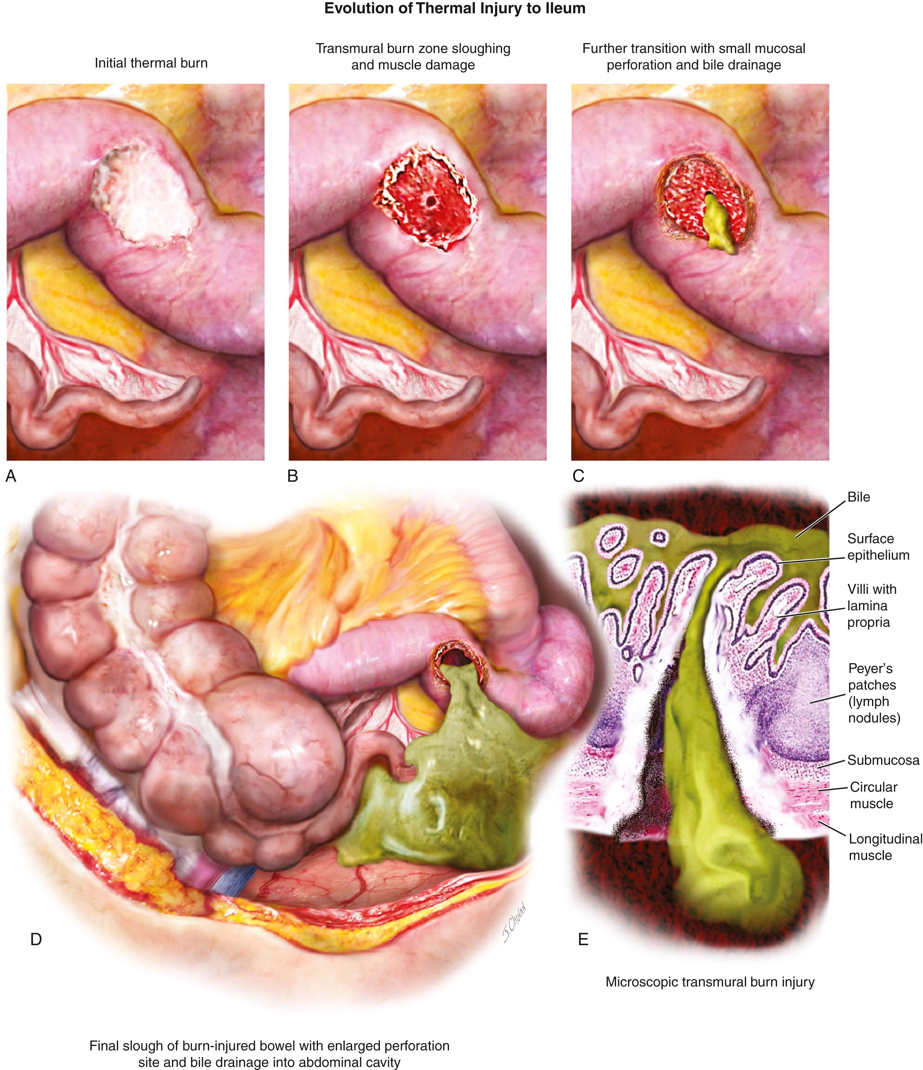 FIG. 119.4, A. A thermal injury creates a white blanching wound of the ileum. B. Within 24 to 36 hours the burn eschar has sloughed, exposing a transmural injury and a tiny perforation. C. As time passes, bile-stained fluid seeps from the perforation. D. The initial wound sloughs secondary to burn-induced necrosis. E. Microscopic section showing the mature transmural perforation.