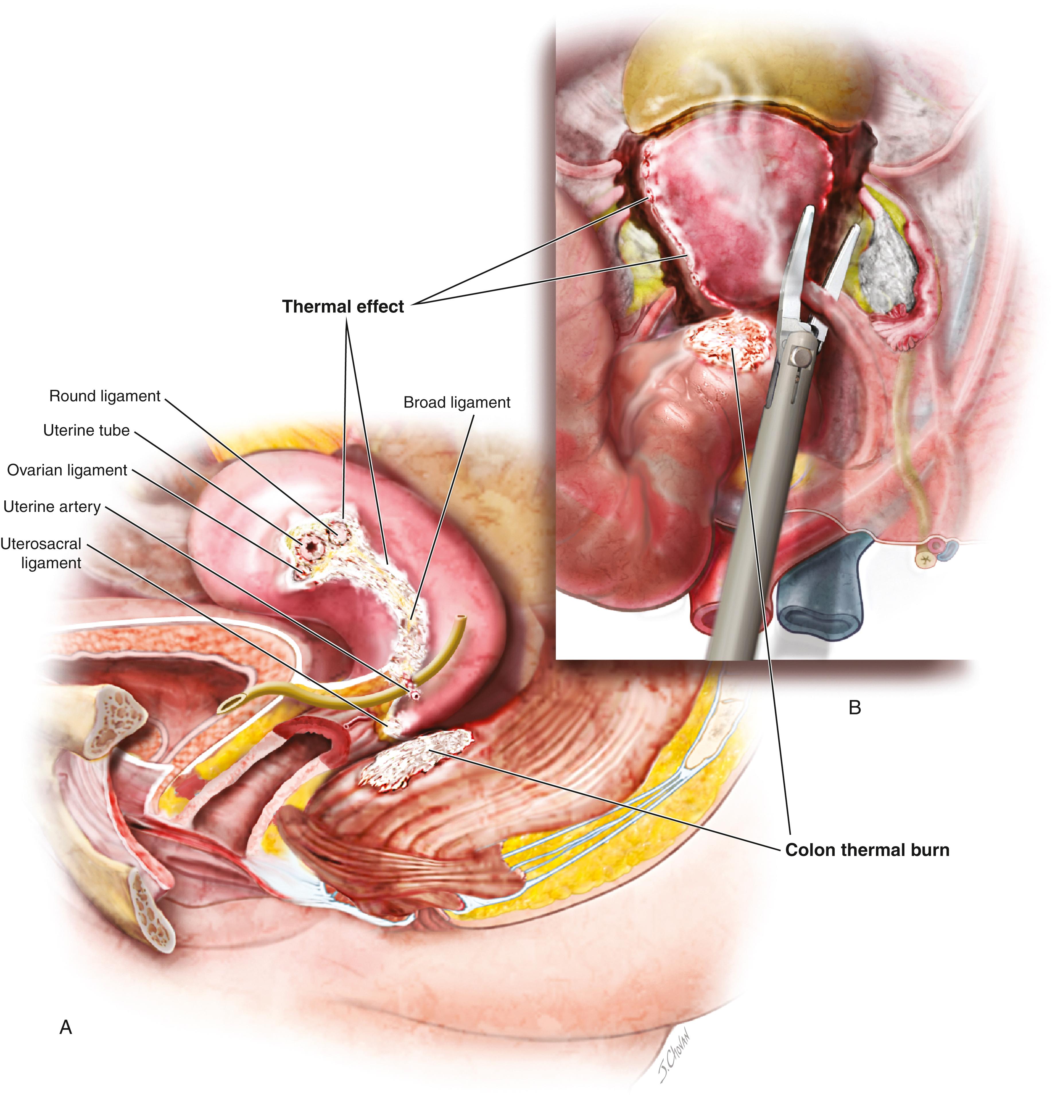 FIG. 119.5, During the course of a laparoscopic hysterectomy using bipolar forceps for hysterectomy, a thermal injury to the sigmoid colon occurs and fails to be recognized. A. After tissue undergoes coagulation, the blood supply is sealed off, leading to ischemia. The denatured protein is blanched white, and eschar is created. B. (inset) LigaSure bipolar forceps (Medtronic-Covidien, Dublin, Ireland) grasp and coagulate the uterosacral ligaments. Heat transmits through neighboring tissue and creates a thermal injury to the rectosigmoid colon.