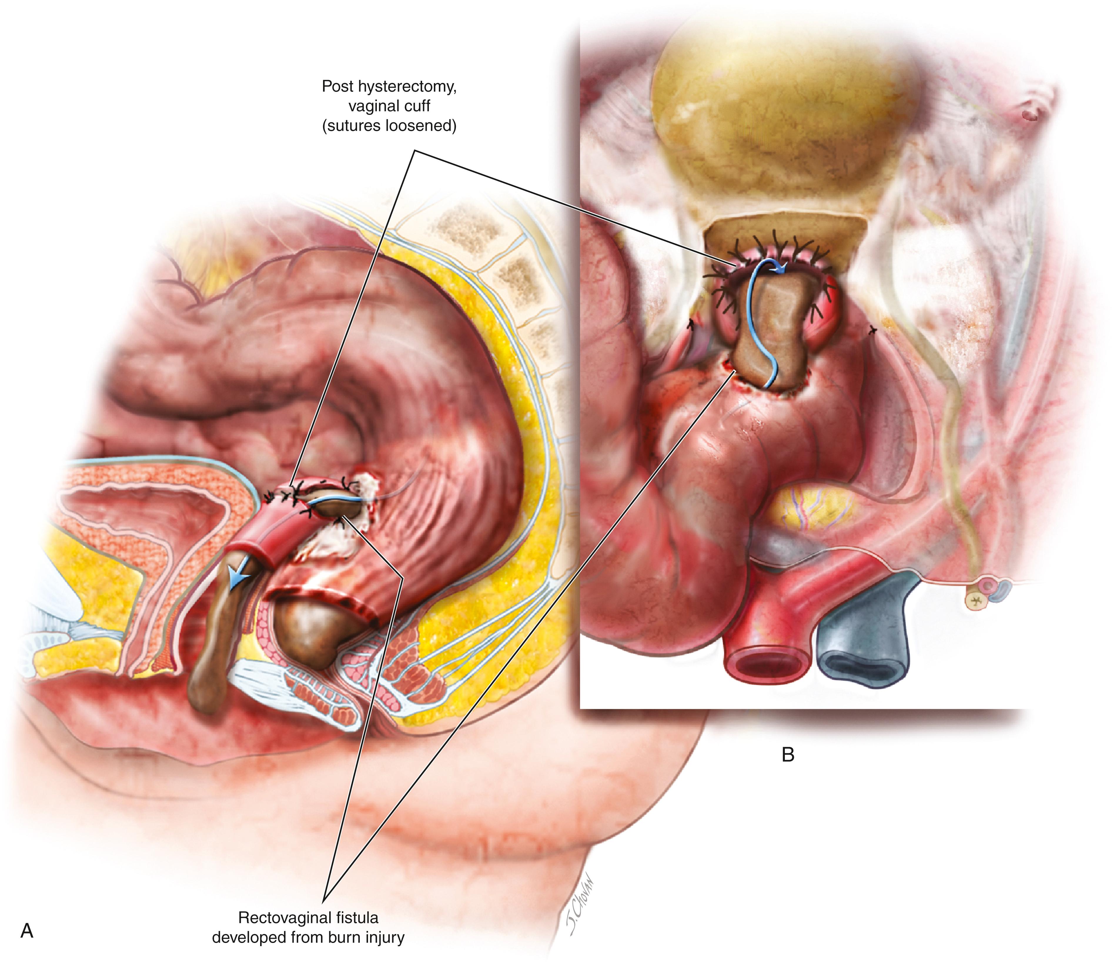 FIG. 119.6, A. The colonic injury subsequently sloughs and drains fecal matter via the cuff (sutures unravel) into the vagina, creating a colonic-vaginal fistula. B. (inset) Magnified view of the colonic-vaginal fecal fistula.