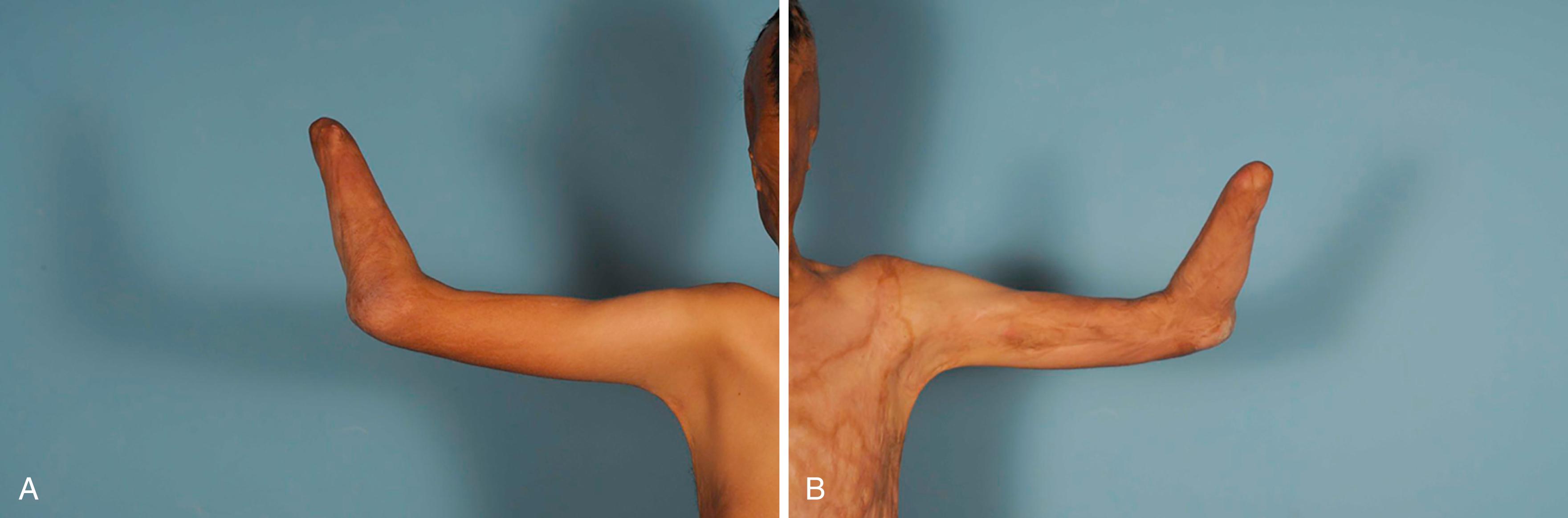 Fig. 50.1, A and B, A 34-year-old man suffering more than 50% total body surface area burns to the head, trunk, and upper extremities requiring bilateral transradial amputations.