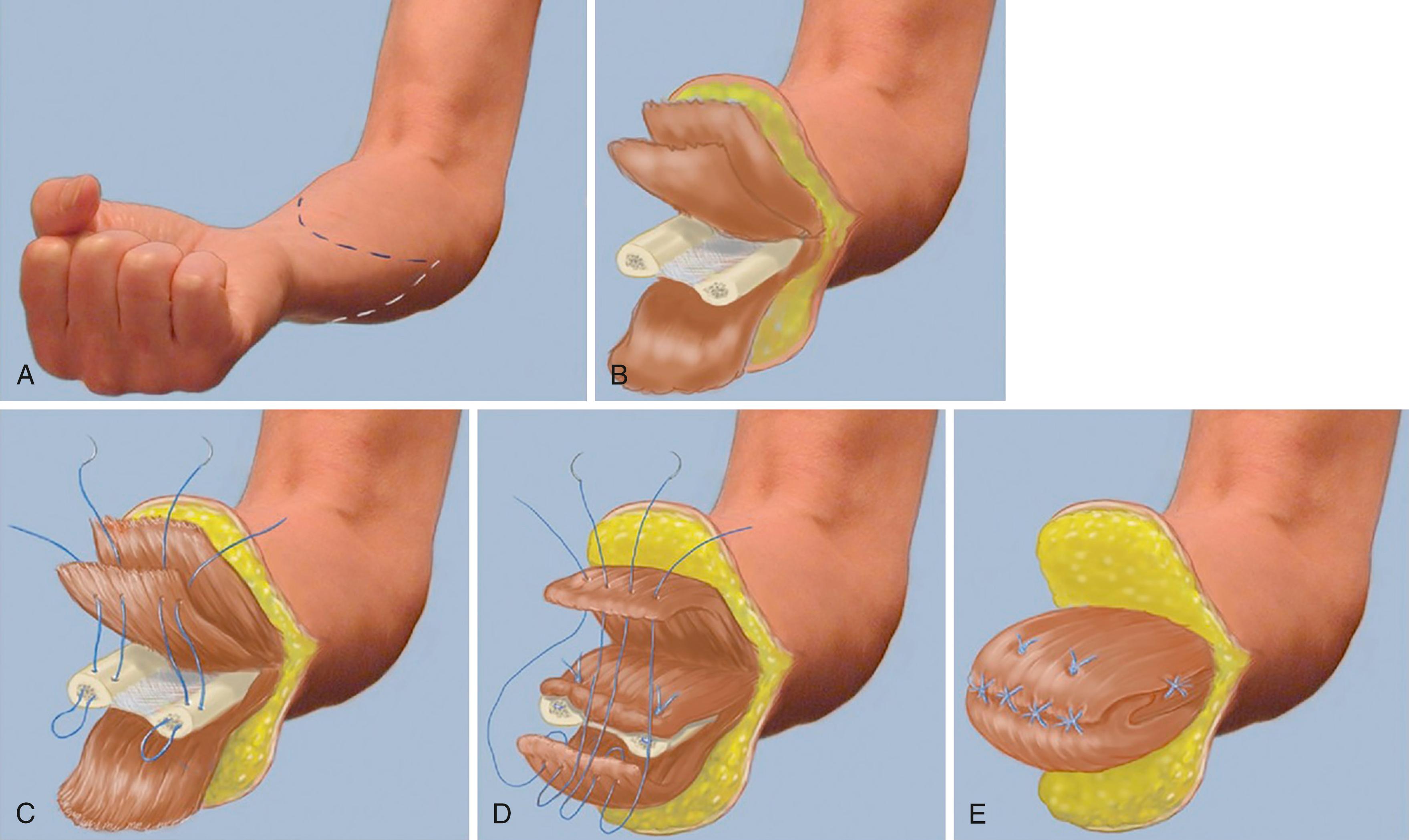 Fig. 50.3, Artist’s rendition of a planned, elective transradial amputation. A, A fish-mouth incision is designed 1 to 2 cm distal to the level of the planned osteotomies, which are usually 8 cm from the ulnar styloid. B, Soft tissues are elevated, and osteotomies completed with an oscillating saw. C, A myodesis is completed with the deep musculature to the bone. D and E, Superficial musculature is sutured in agonist/antagonist pairing over top, trying to re-create physiologic tension.