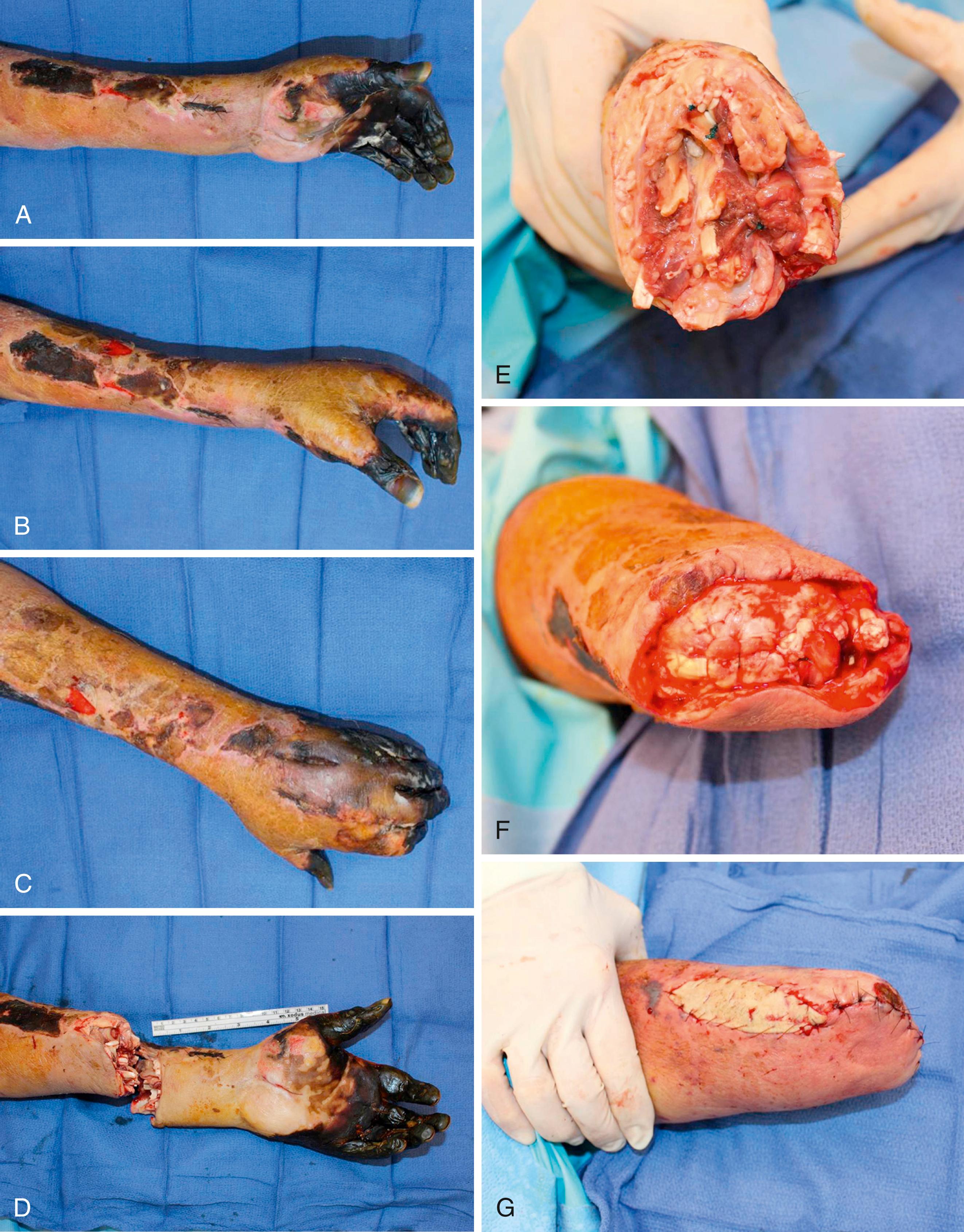 eFig. 50.2, A to C, Incision design. D, Osteotomies 1 to 2 cm proximal to incision line. E, Deep muscle myodesis. F, Superficial muscle myoplasty. G, “Spare parts” full-thickness skin graft.