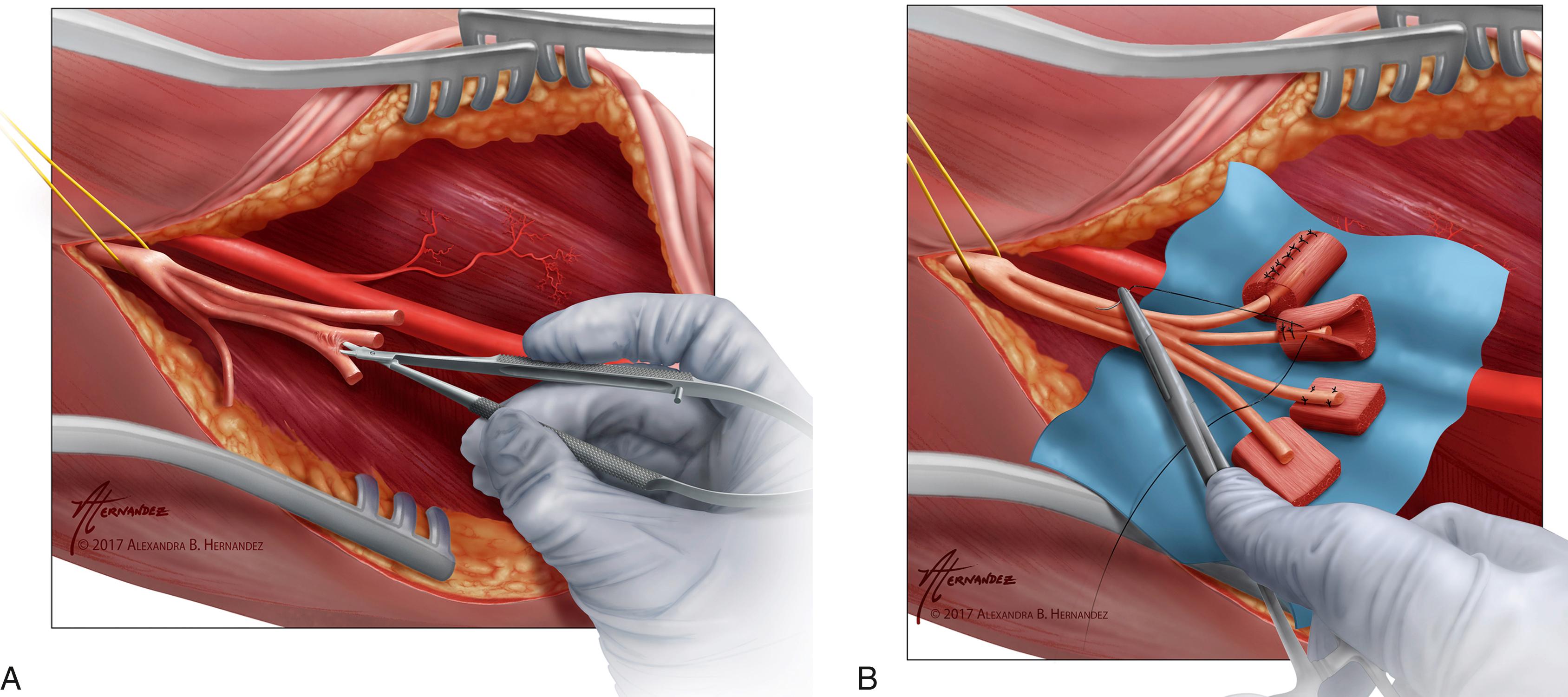 Fig. 50.4, A, A major peripheral nerve is split along fascicular planes with careful microsurgical dissection. B, Muscle grafts are sutured to the terminal nerve ends to create regenerative peripheral nerve interfaces (RPNIs).