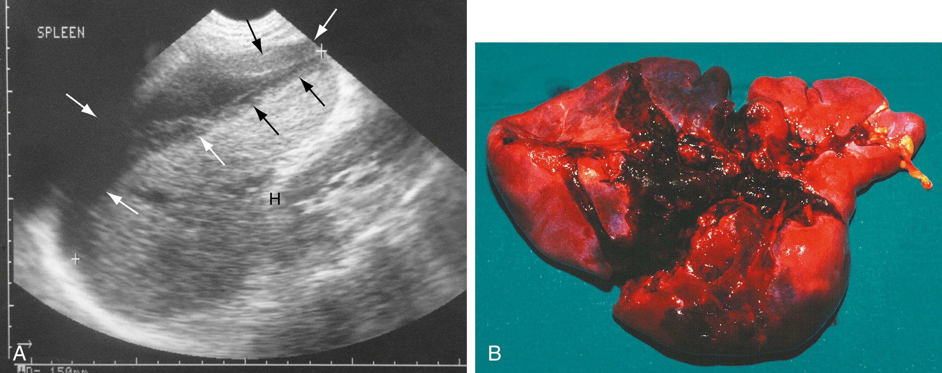 Fig. 15.7, Ruptured Spleen.