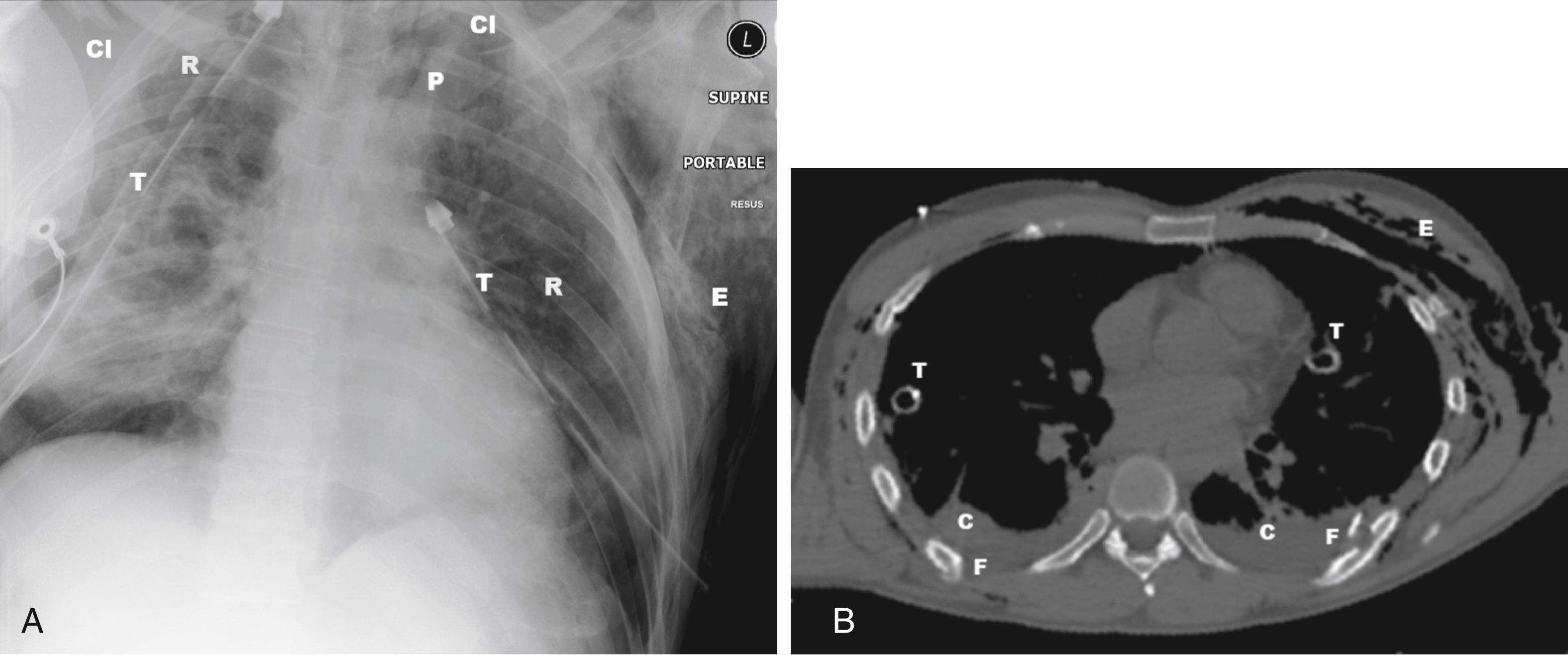 Fig. 15.9, Serious Chest Injuries.