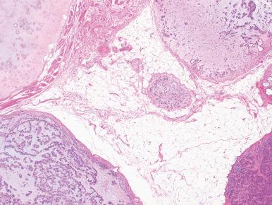 Figure 6.12, Recurrent benign mixed tumors typically appear as multiple small tumors distributed in residual gland tissue, as well as periglandular soft tissue.