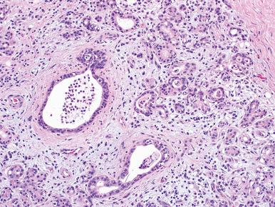 Figure 6.2, Obstructive sialadenitis associated with submandibular gland sialolithiasis. The parenchyma is atrophic with mixed acute and chronic inflammation including intraluminal neutrophils.