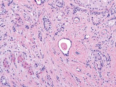 Figure 6.4, Sclerosing polycystic adenosis. Small tubules and epithelial nests composed of cells with apocrine cytology are present within a collagenous stroma. Note the eosinophilic cytoplasmic granules in the bottom left.