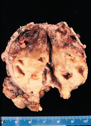 Figure 6.6, A, Gross appearance of lymphoepithelial sialadenitis (LESA) of parotid gland. There is a combination of solid areas resulting from infiltration by lymphocytes and small cystic formations representing dilated ductal lumina. B, Prominent proliferation of duct epithelium in a patient with LESA disease.