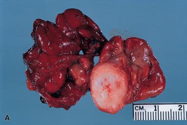 Figure 6.7, A–C, Gross appearance of three benign mixed tumors of parotid gland. Note the sharply outlined character and predominantly solid cut surface. The tumors shown in A and B have a glistening surface indicative of cartilaginous differentiation, whereas the tumor in C has a more myxoid or gelatinous appearance.