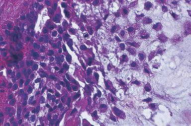 Figure 6.9, Benign mixed tumor. The myoepithelial cells are undergoing cartilaginous metaplasia and appear to “melt” into the chondromyxoid stroma they are producing.