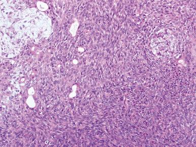 Figure 6.10, Benign mixed tumor with a markedly hypercellular appearance.