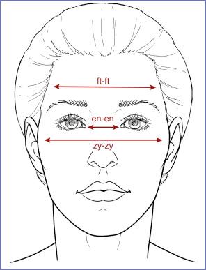 Fig. 9.1, The only anthropometric measurement relative to the malar bone is zy–zy, which measures midface width. Similarly, there are no cephalometric landmarks to assess malar projection.