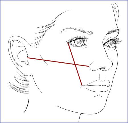 Fig. 9.3, Hinderer’s lines are two intersecting lines. One is drawn from the ala to the tragus and the other from the oral commissure to the lateral canthus. He advocated placing the implant in the upper outer quadrant formed by these intersecting lines. 4