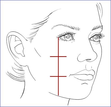 Fig. 9.4, Wilkinson proposed a method for determining the point of maximum malar projection. He dropped a line vertically from the lateral canthus to the mandibular border, then divided it into thirds. The malar prominence should lie just lateral to the point one-third down from the canthus. 6