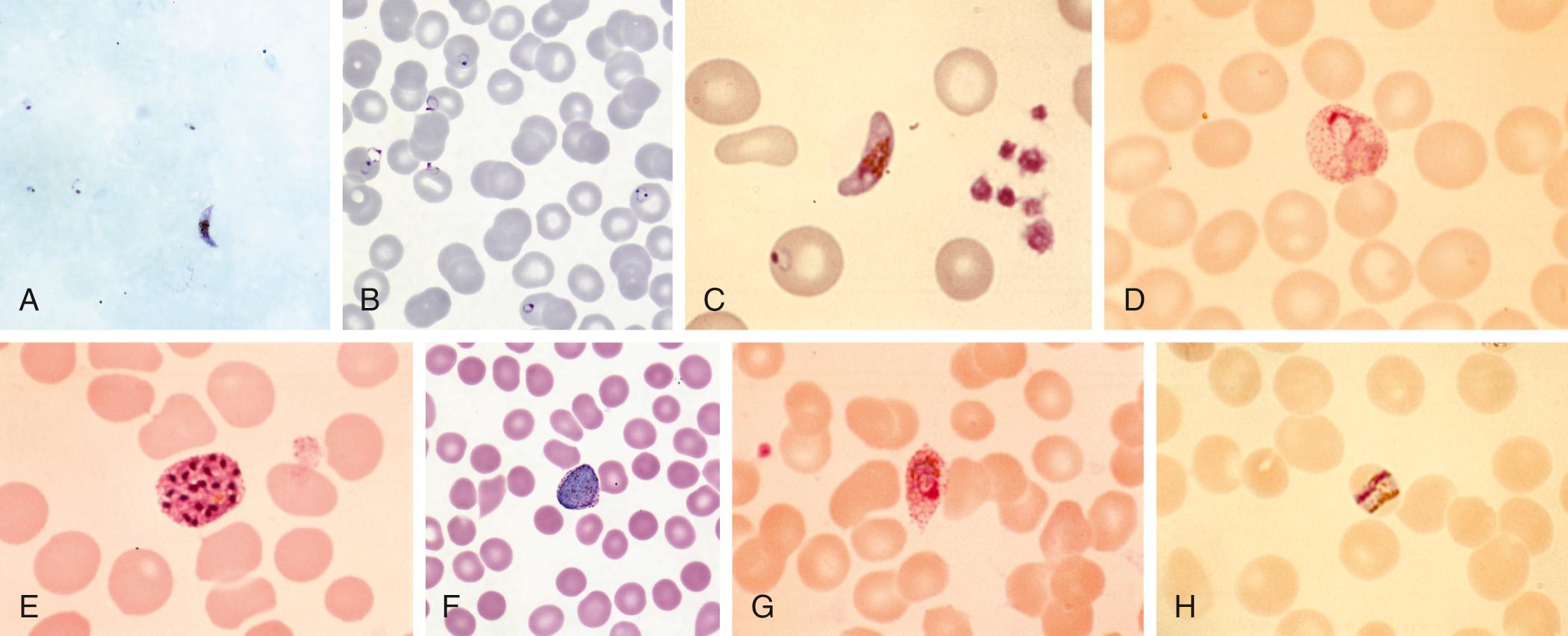 Fig. 314.3, Giemsa-stained thick ( A ) and thin ( B-H ) smears used for the diagnosis of malaria and the speciation of Plasmodium parasites.