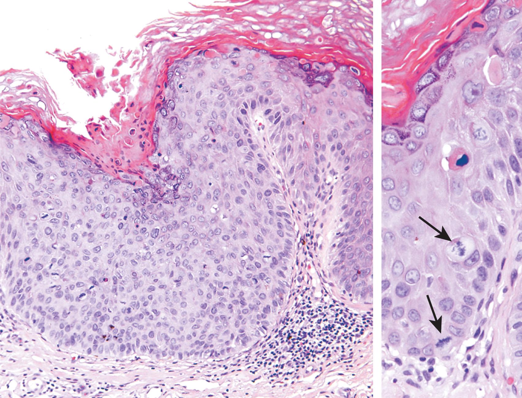 FIG. 16.1, High grade penile intraepithelial neoplasm (PeIN). The epithelium above the intact basement membrane shows delayed maturation and disorganization (left). Higher magnification (right) shows several mitotic figures (arrows) , one above the basal layer.