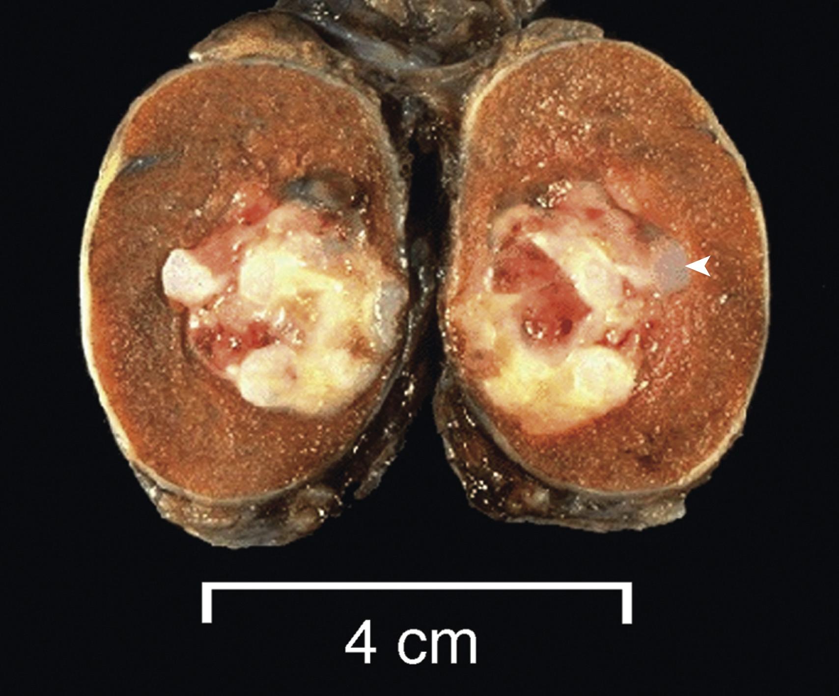 eFIG. 16.2, This small testicular neoplasm within the body of a normal-sized testis sectioned coronally has a mixture of bluish cartilage (arrowhead) admixed with red and white tumor tissue. Microscopically it contained mainly teratoma but also areas of embryonal carcinoma.